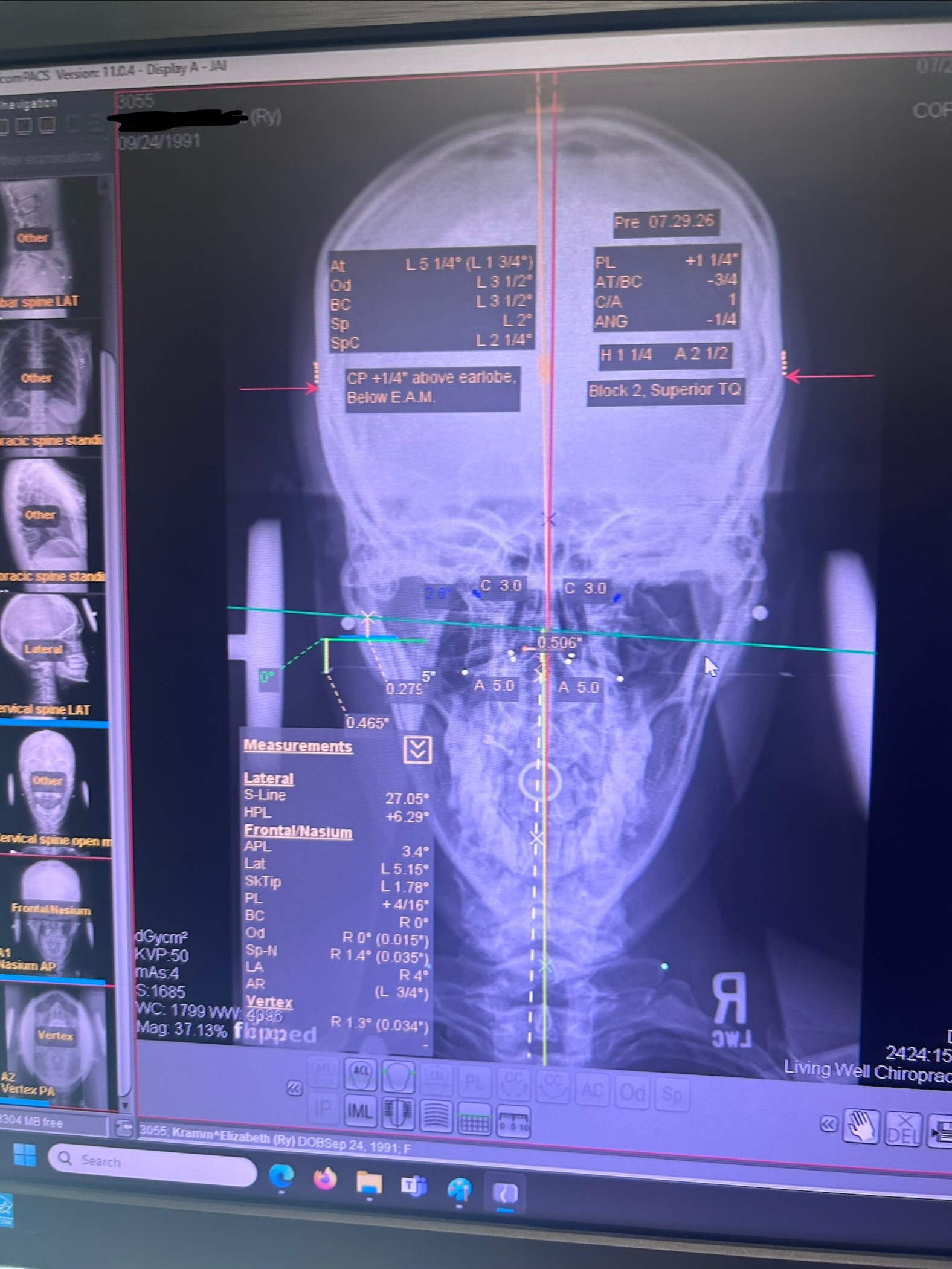 Help Ry Fix Her Spine with PICL procedure campaign photo, 4 of 6