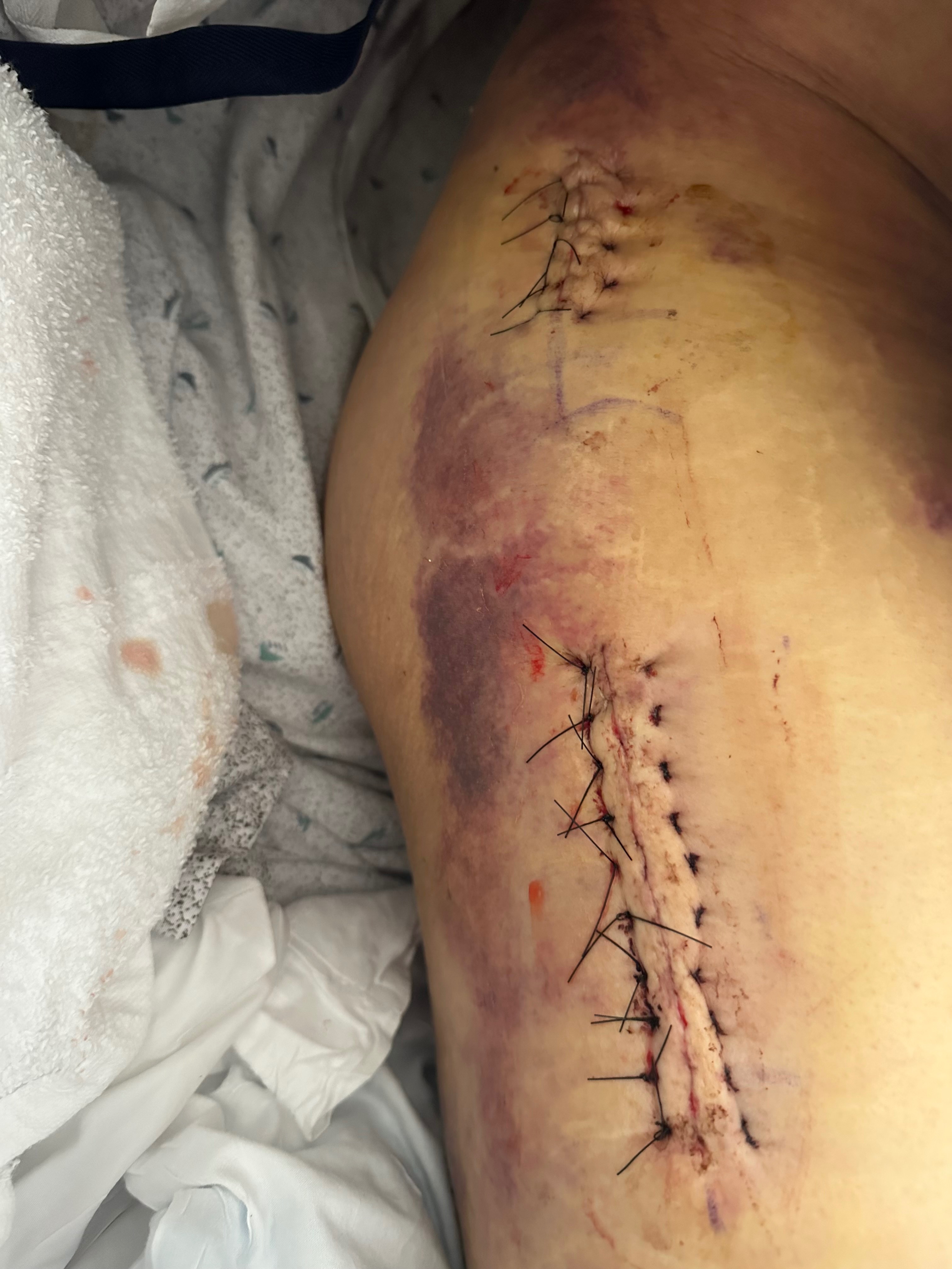 Help abel e Recover from Surgery campaign photo, 7 of 8