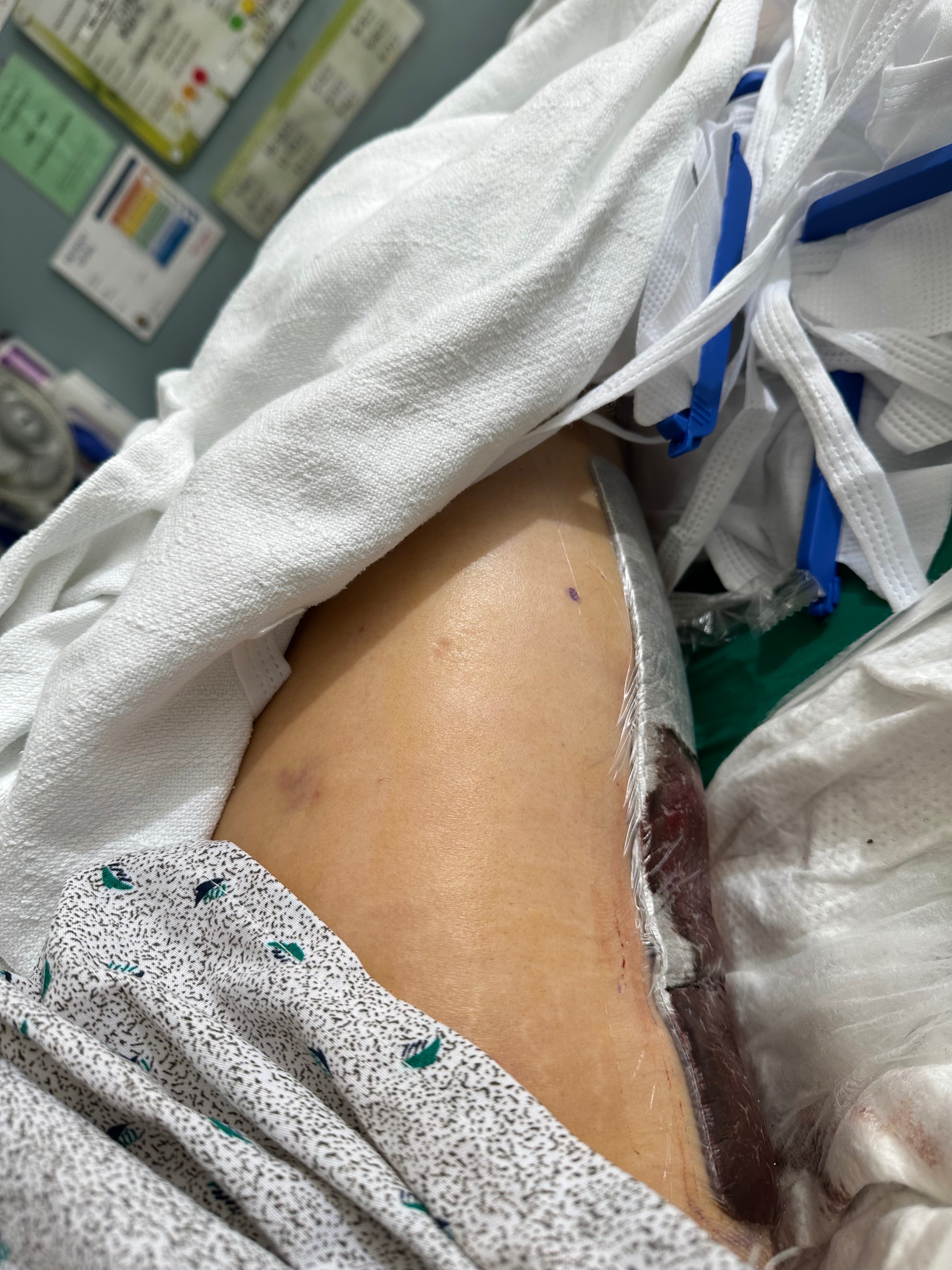 Help abel e Recover from Surgery campaign photo, 2 of 8