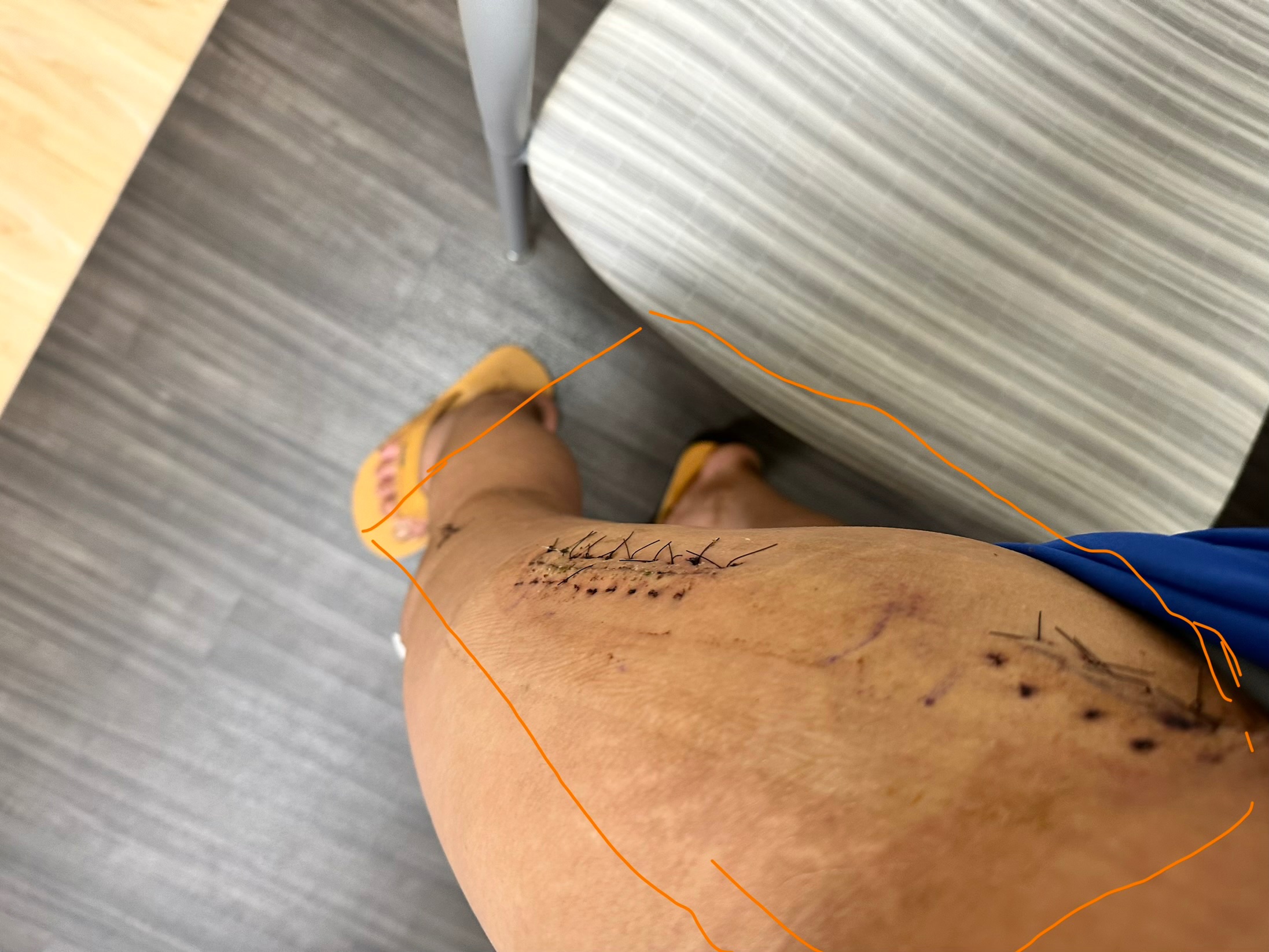 Help abel e Recover from Surgery campaign photo, 6 of 8