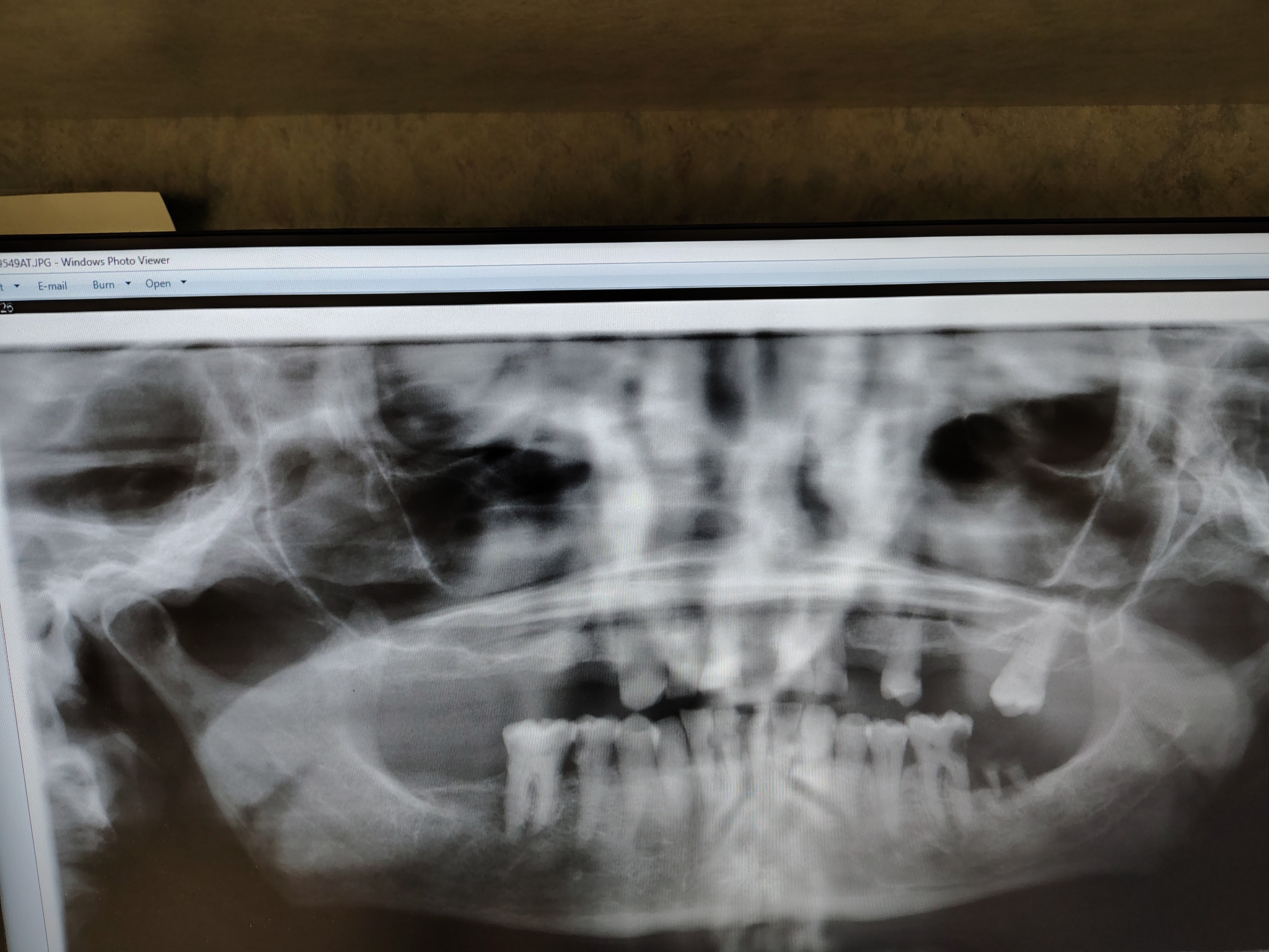 Help me Please! No cavities. My teeth are crumblin campaign photo, 4 of 13