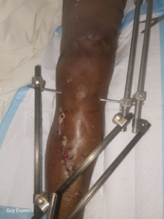 Help Guy Walk Again After Haiti Accident campaign photo, 4 of 7