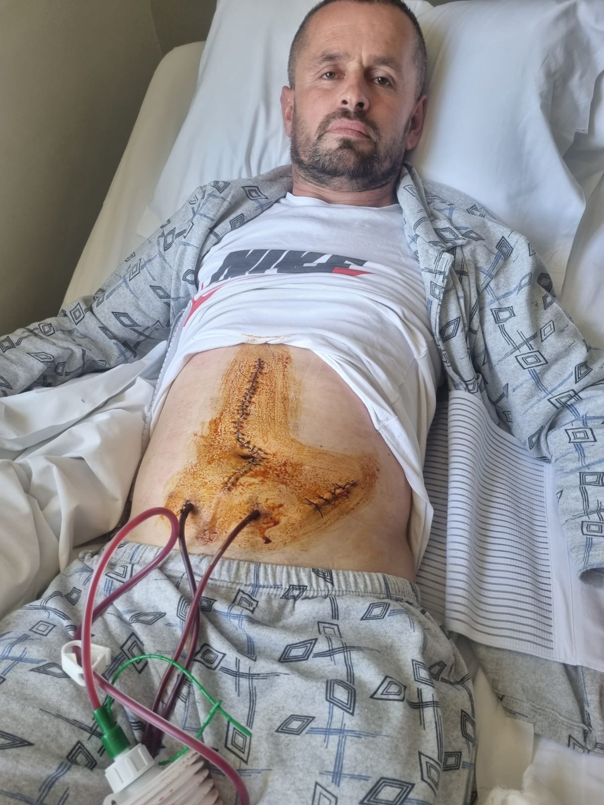 Stabbed for Stopping Crime: Help Ibrahim Fund His 4th Surger campaign photo, 2 of 7