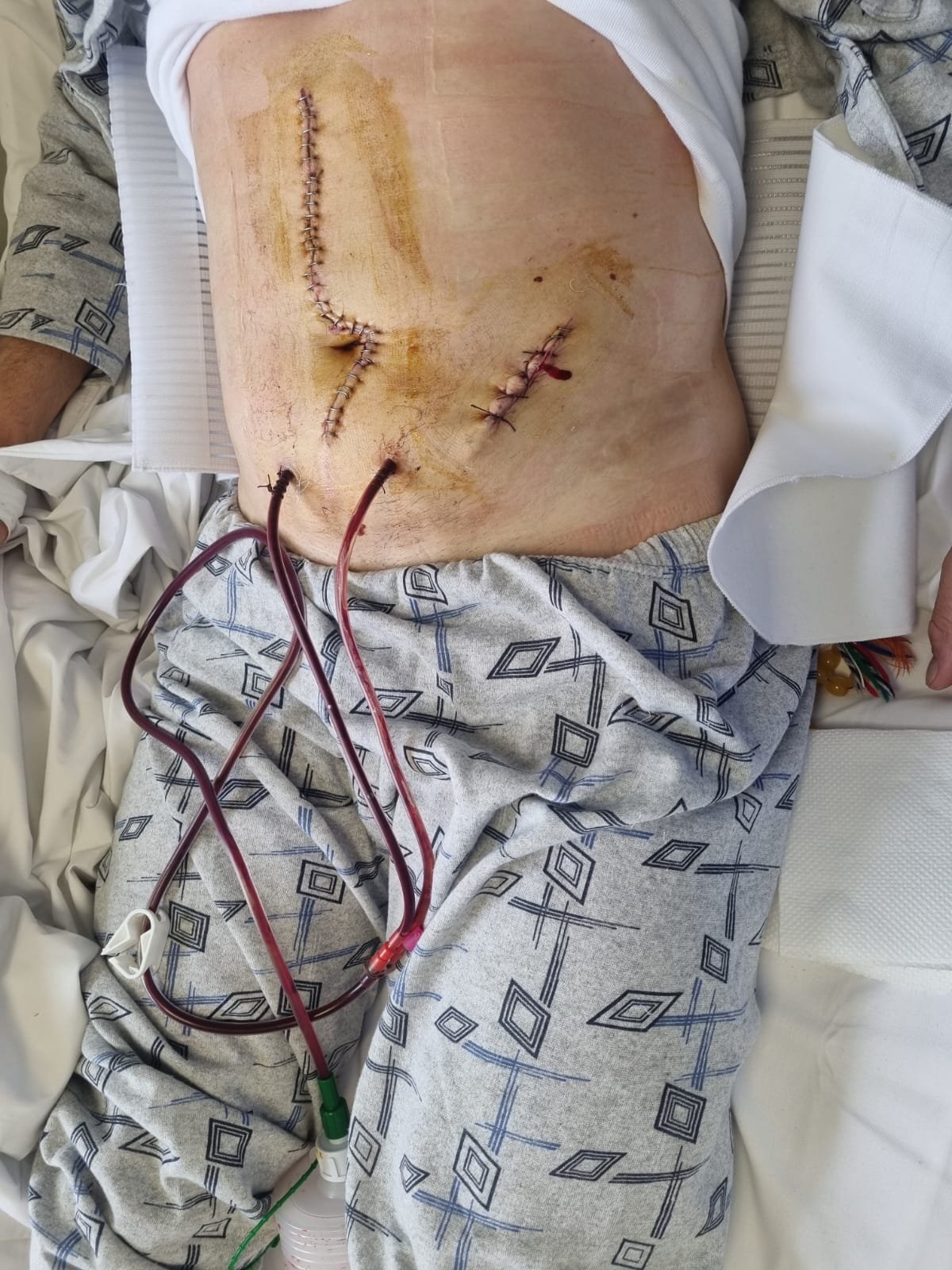 Stabbed for Stopping Crime: Help Ibrahim Fund His 4th Surger campaign photo, 5 of 7