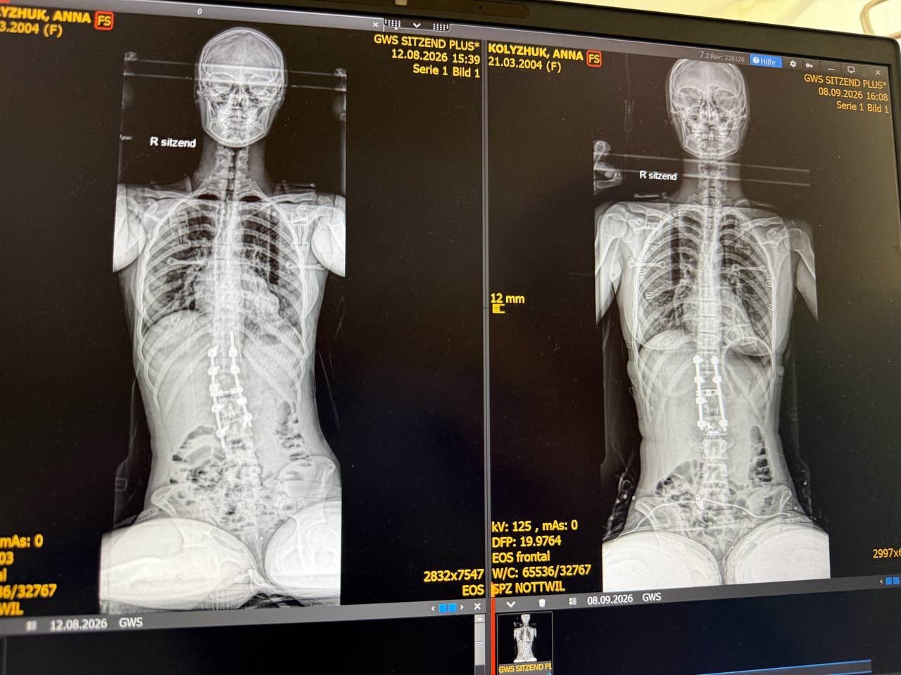Help Anna Kolyzhuk Rebuild Her Life After a Spinal Injury campaign photo, 6 of 8