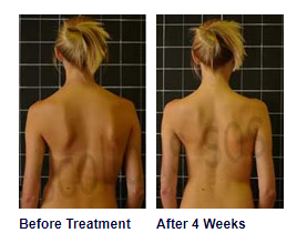 Help Fund Life-Changing Scoliosis Treatment campaign photo, 2 of 4