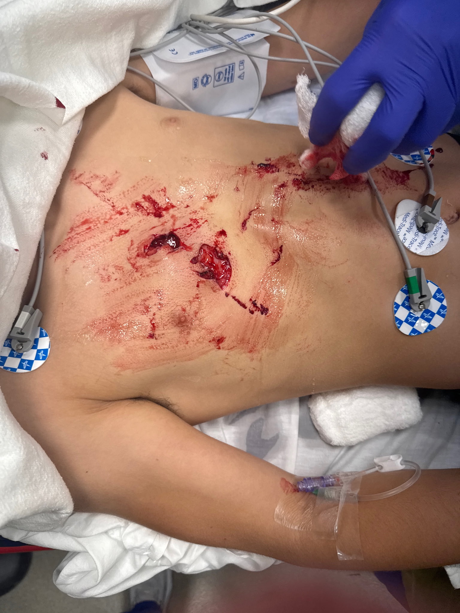 Support Dominick’s Recovery After Beaver Attack campaign photo, 5 of 6