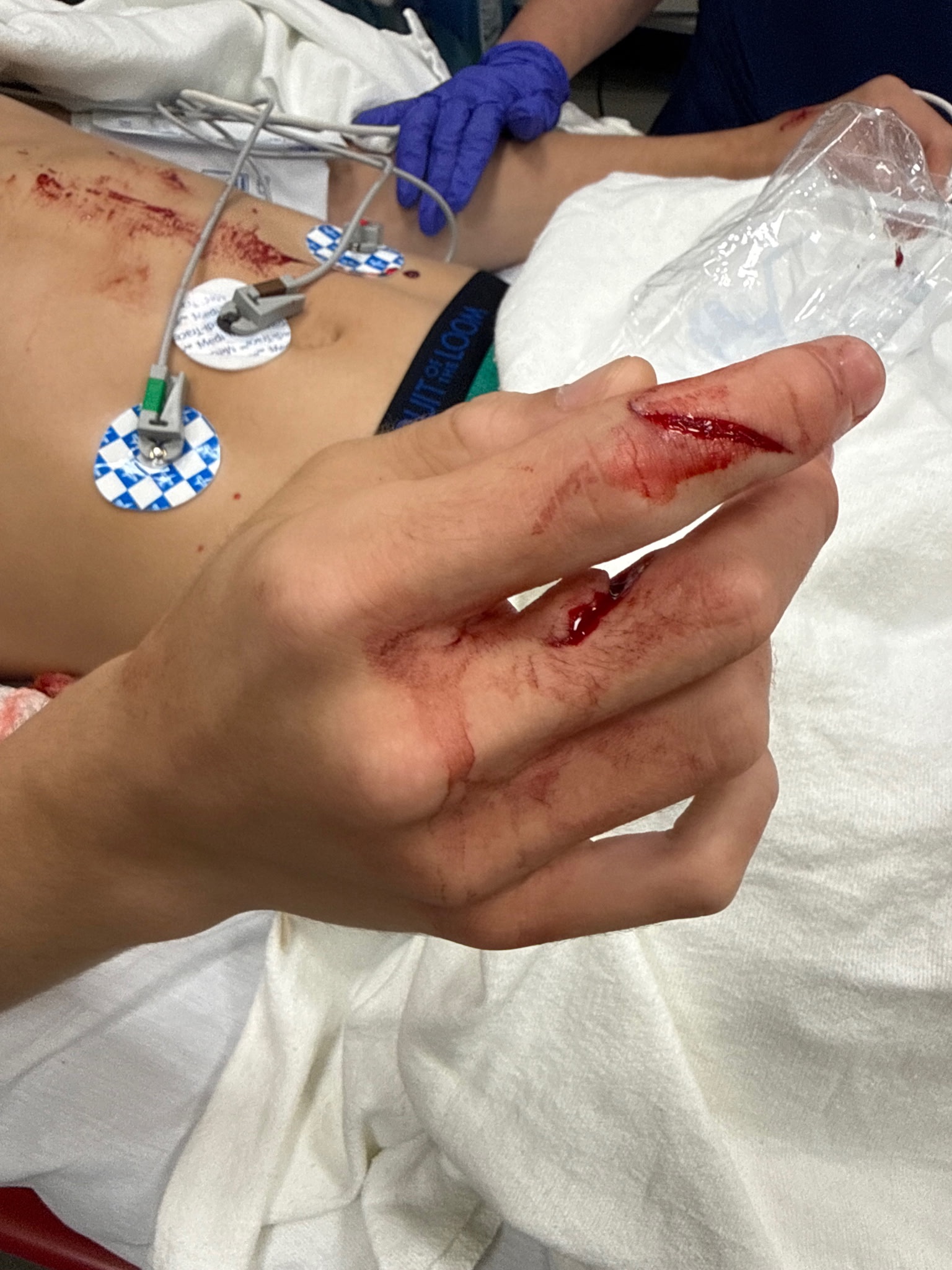 Support Dominick’s Recovery After Beaver Attack campaign photo, 2 of 6