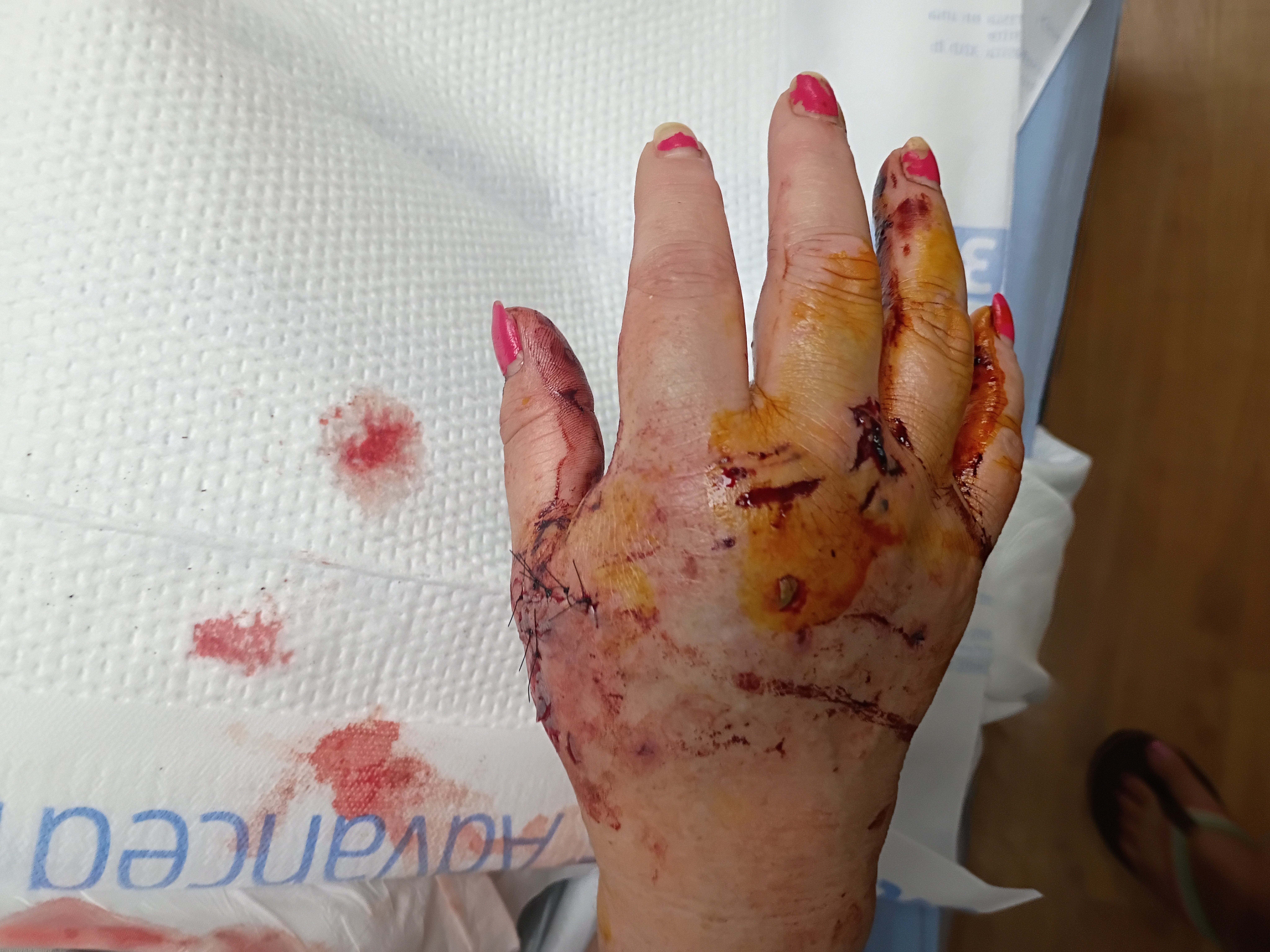 Supporting Angie While Recovering From Dog Attack campaign photo, 4 of 5