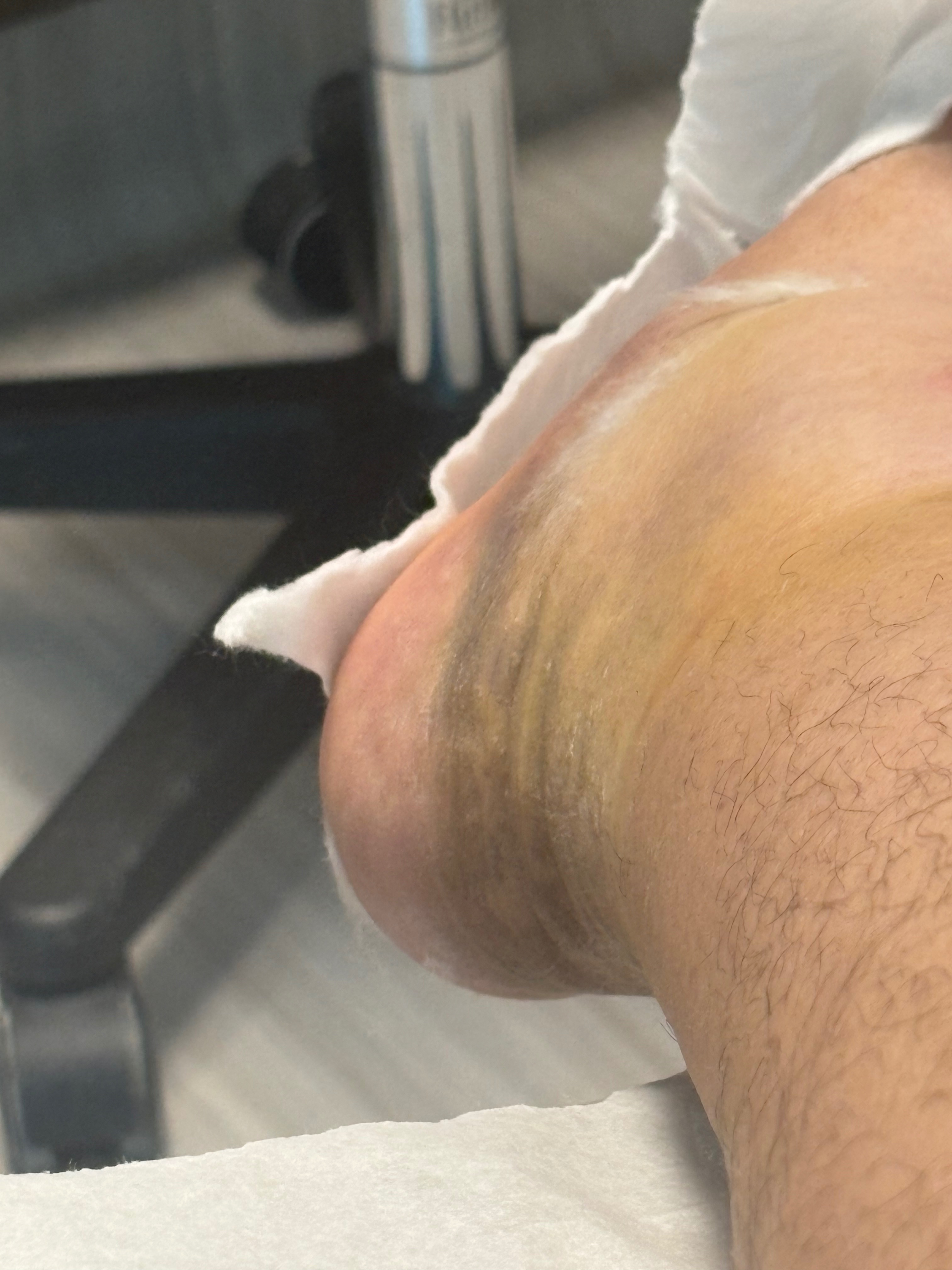 Support Joe During Ankle Recovery campaign photo, 4 of 8