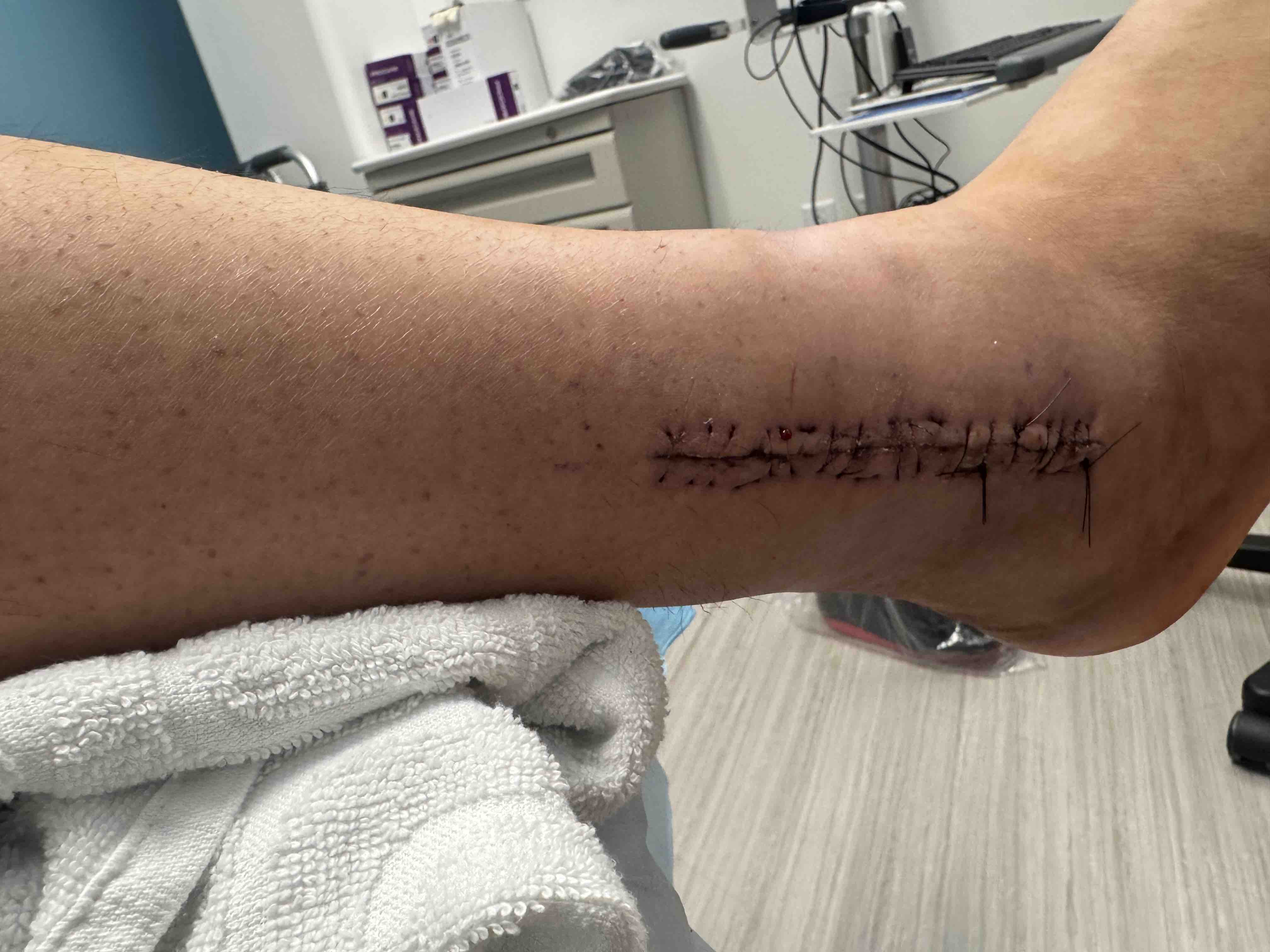 Support Joe During Ankle Recovery campaign photo, 6 of 10
