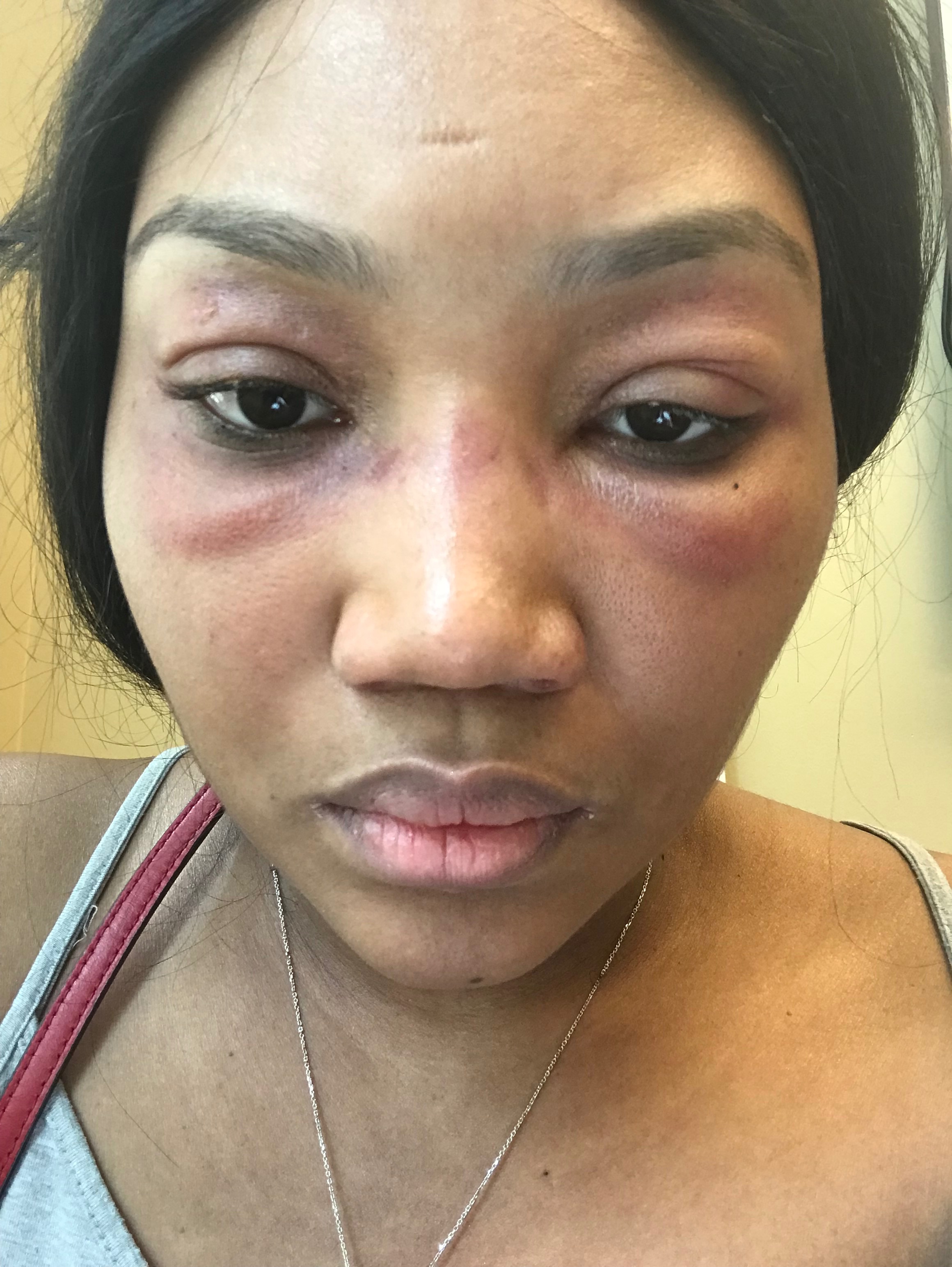 Help Luz Get Stem Cell Treatment in México campaign photo, 7 of 8