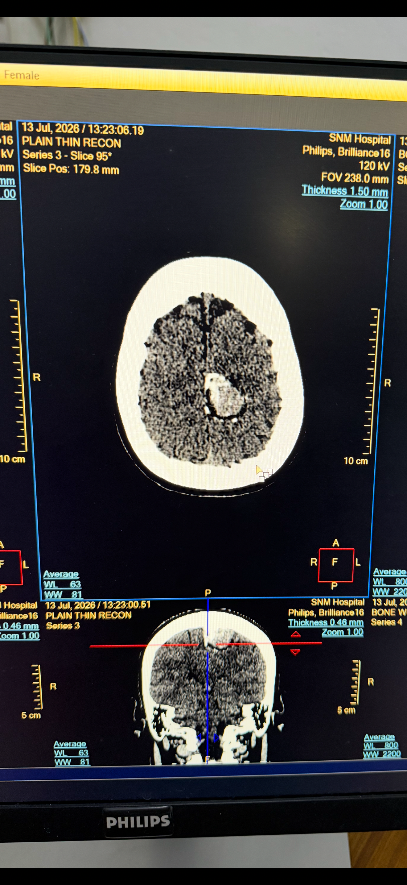 Help Lynn Through Brain Tumor Treatment campaign photo, 2 of 6