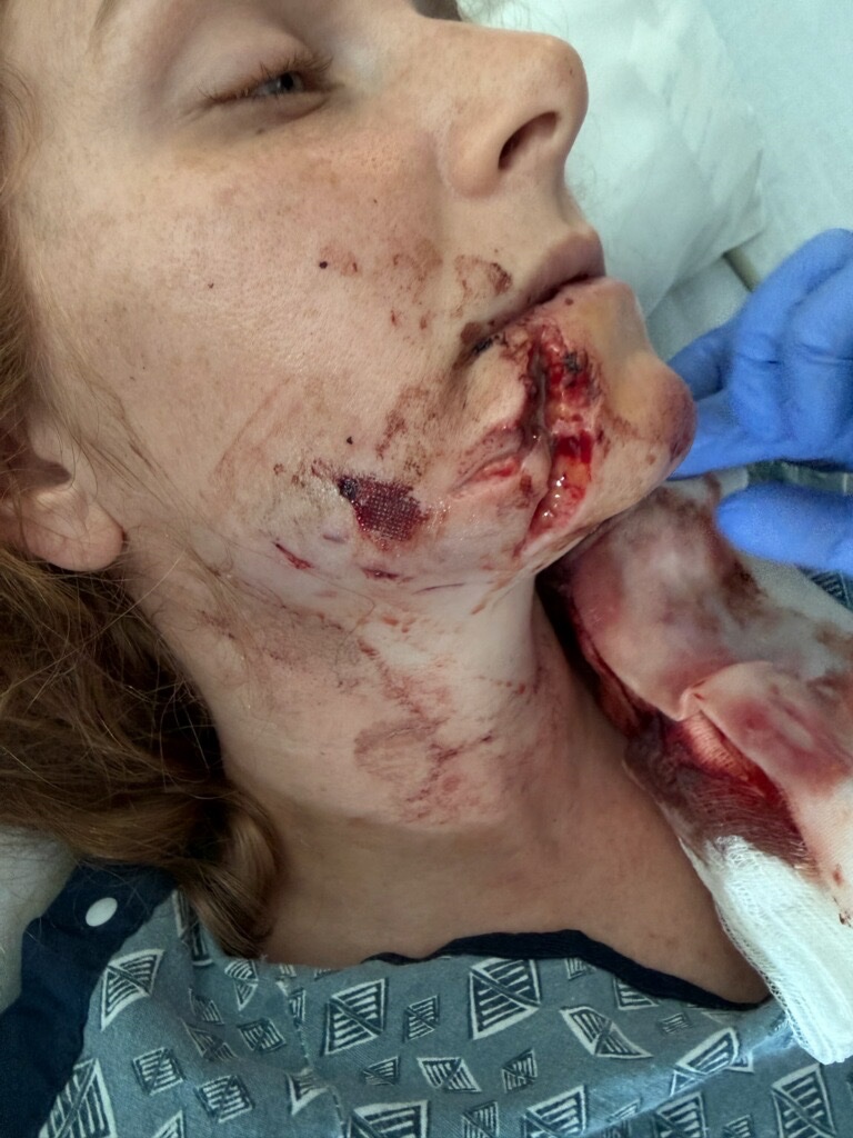 Support Courtenay’s Recovery After Dog Attack campaign photo, 2 of 8