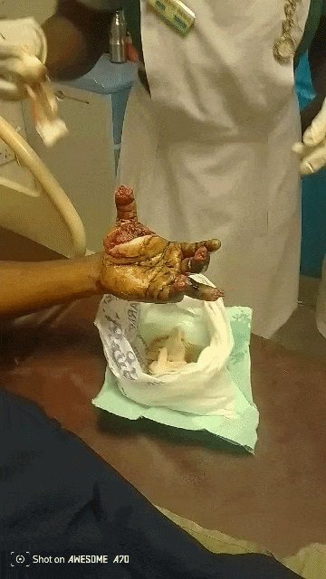 Help Thomas Recover After a Devastating Hand Accident campaign photo, 4 of 6