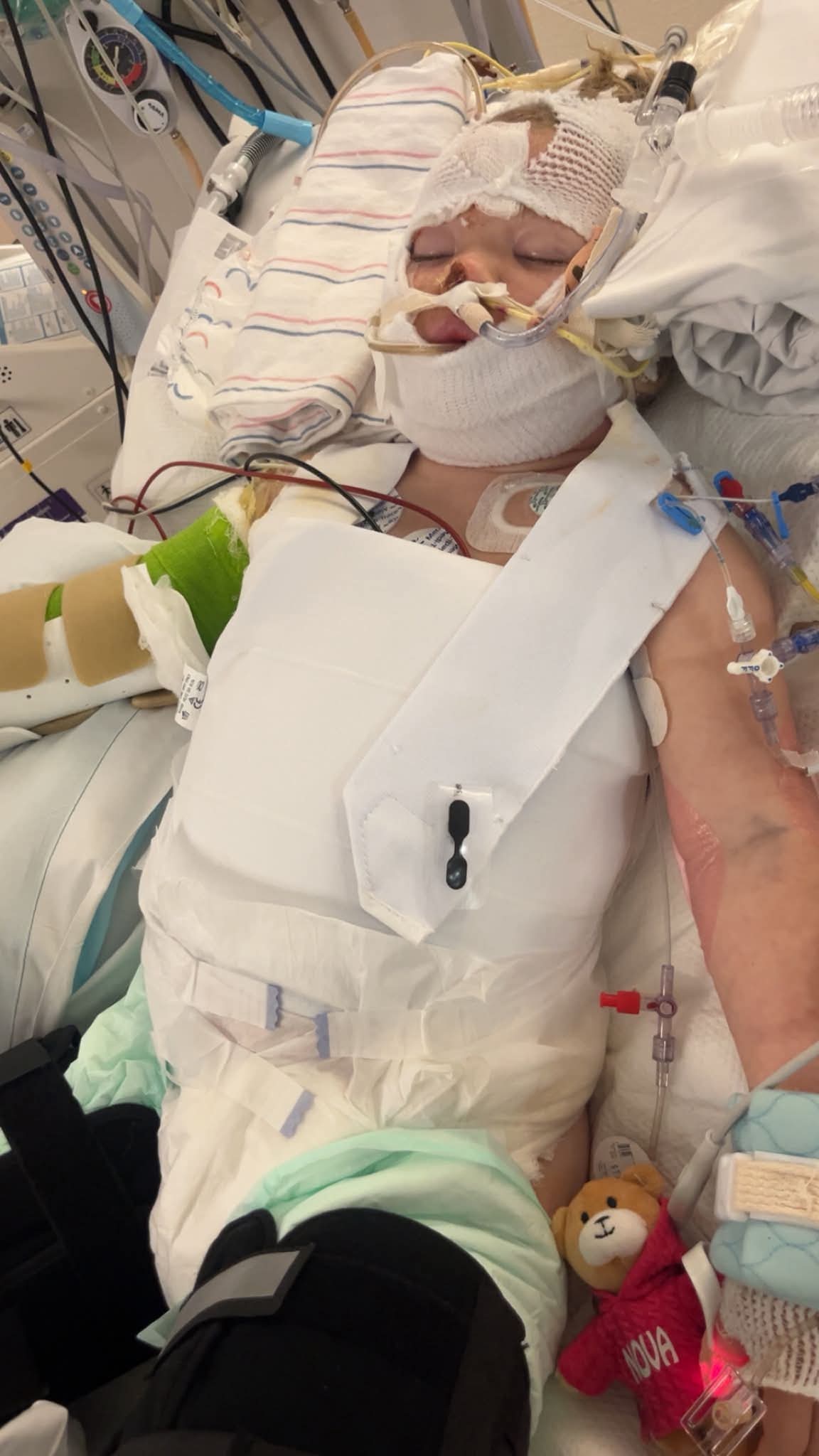 Support Nova and Jared's Burn Recovery campaign photo, 10 of 13