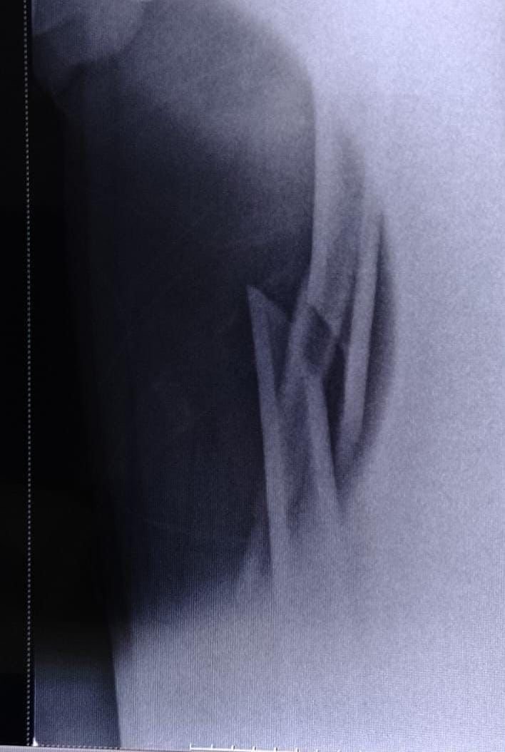 Help Rolando Cover Medical Costs After Surfing Injury campaign photo, 4 of 7