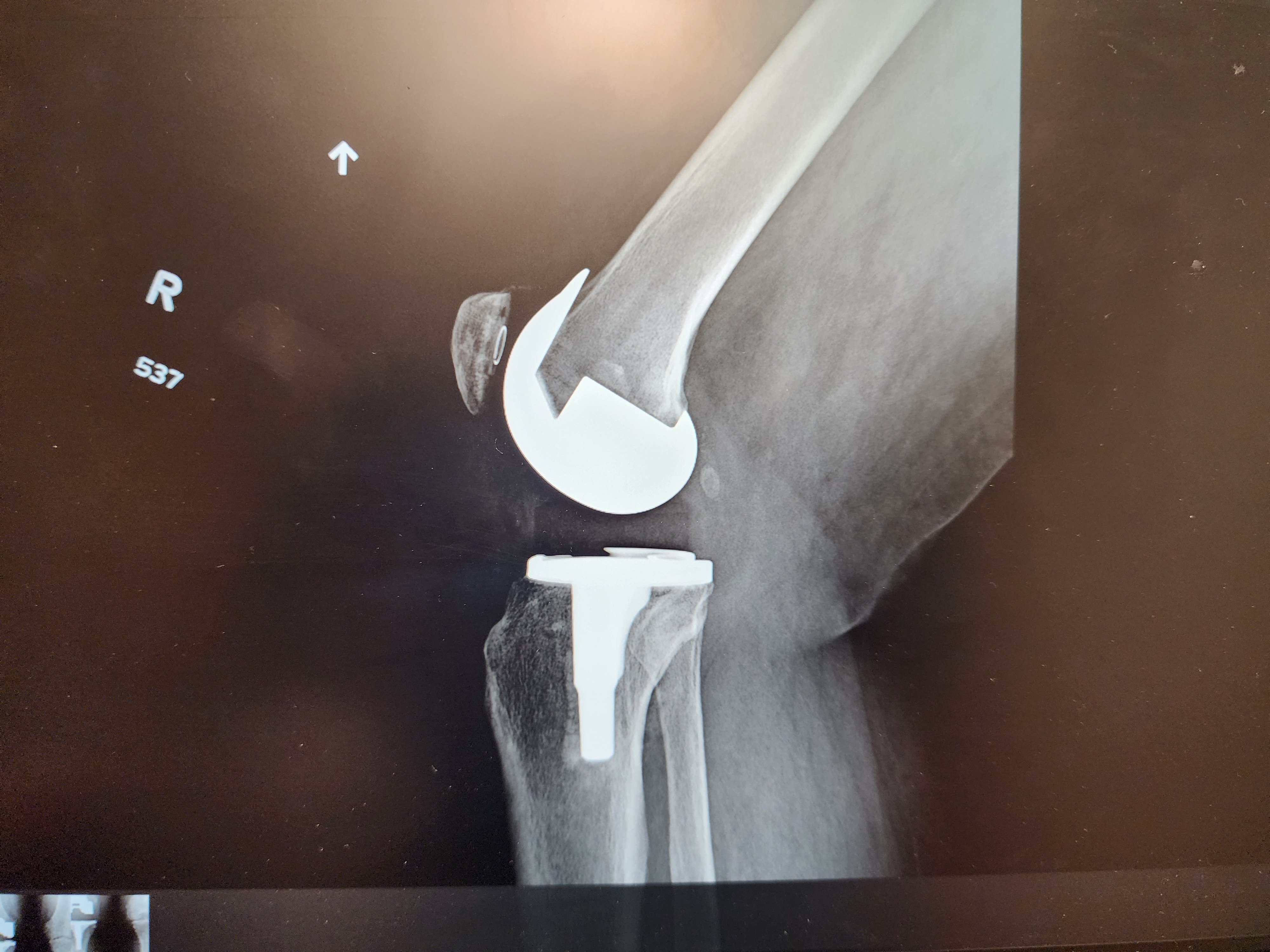 Aid My Recovery from Double Knee Replacement campaign photo, 4 of 5