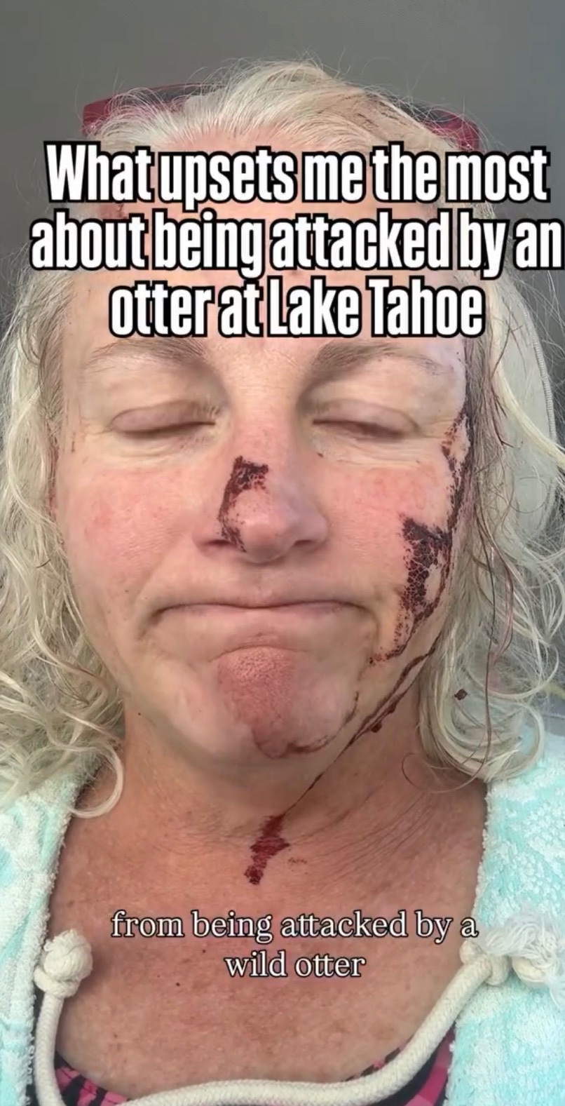 Help Lynette Recover from Lake Tahoe Otter Attack campaign photo, 2 of 3