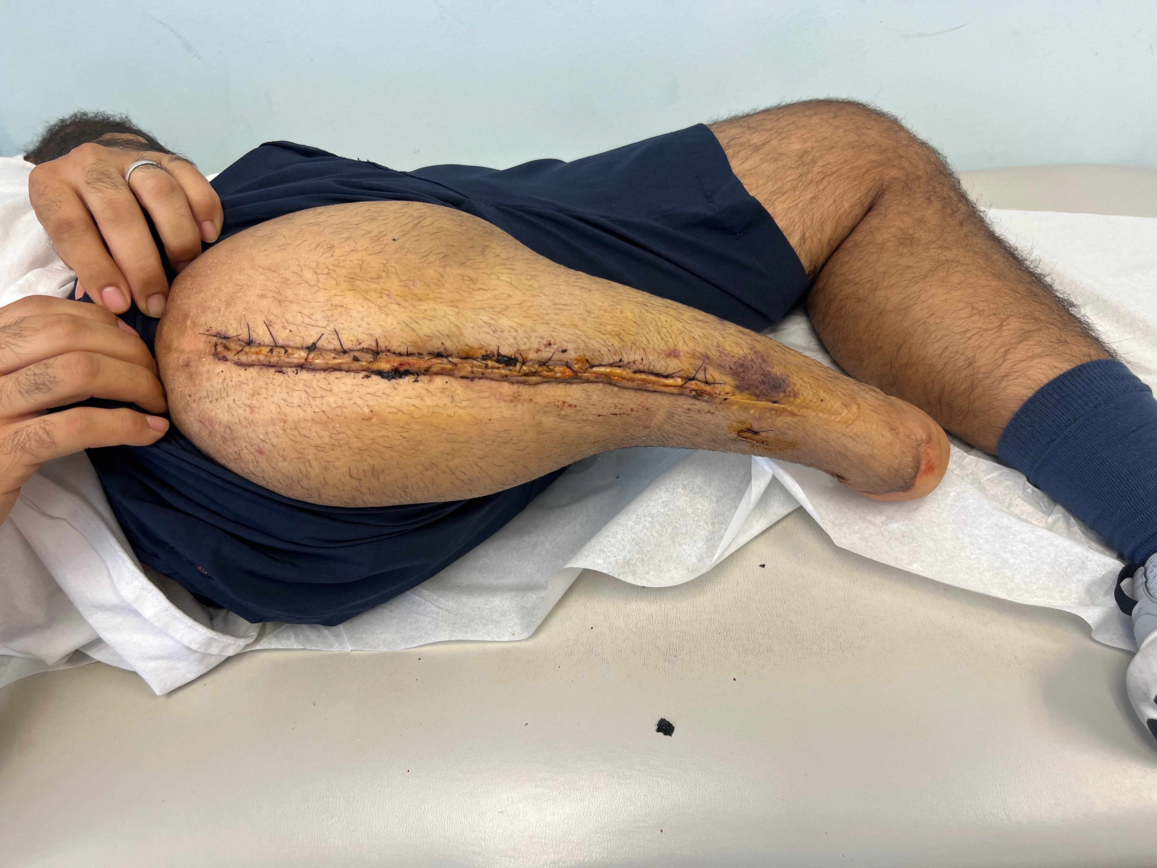 Foto della campagna Cristian's Recovery After Emergency Surgery, 4 di 7