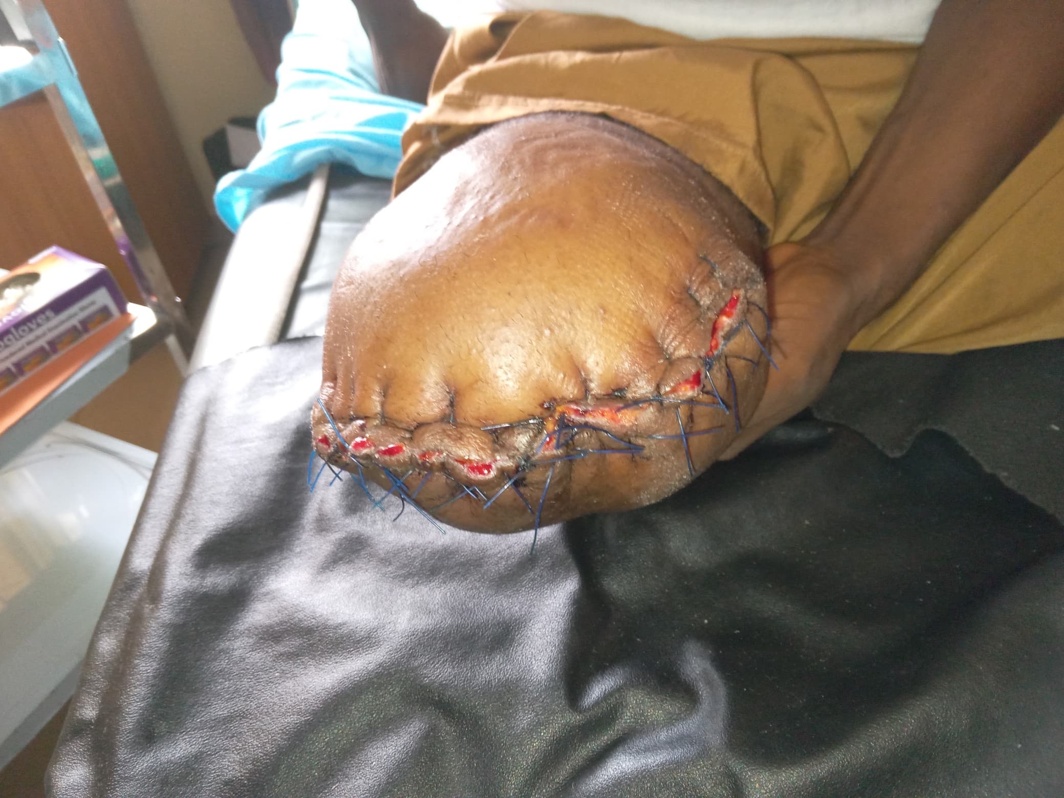 Help get a prosthetic leg and pay medical bills campaign photo, 4 of 5