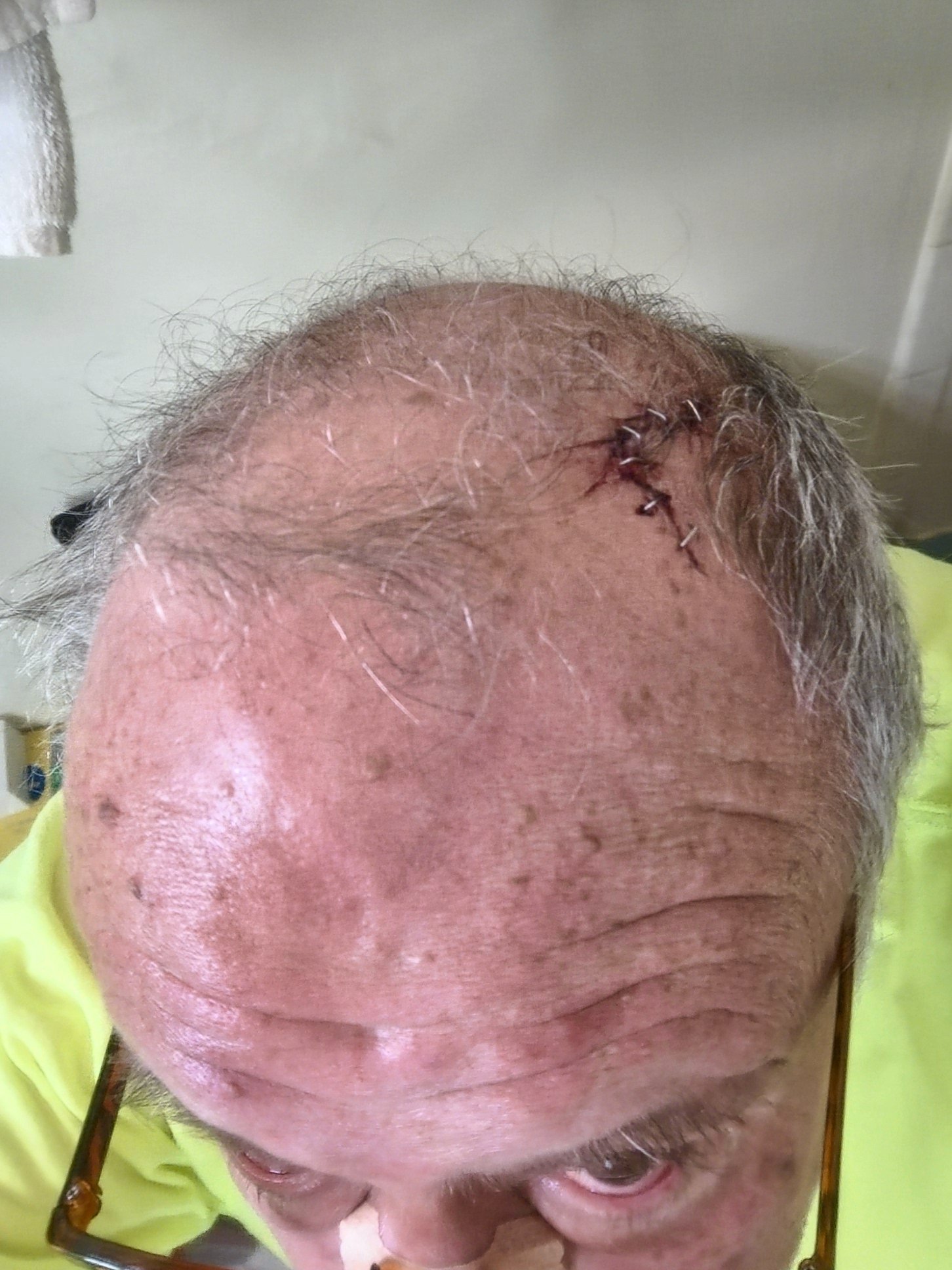Cover Erik's grade 1 Spondylolisthesis Care and Lost Income campaign photo, 6 of 8