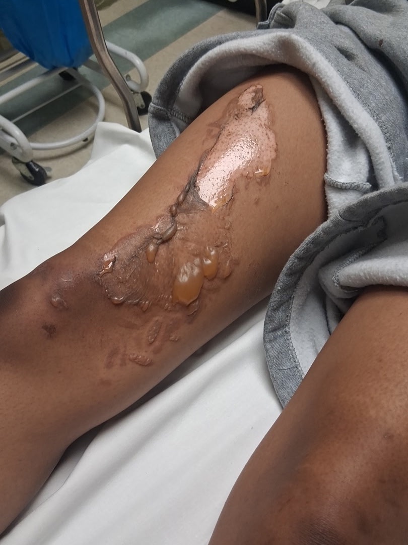 Aid for Bridgette's Burn Treatment and Recovery campaign photo, 5 of 6
