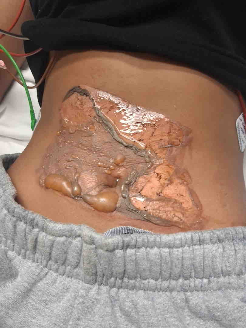 Aid for Bridgette's Burn Treatment and Recovery campaign photo, 2 of 6