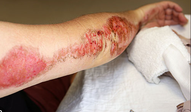 Help Nool Rams Cover Accident Medical Bills and Rent campaign photo, 2 of 5