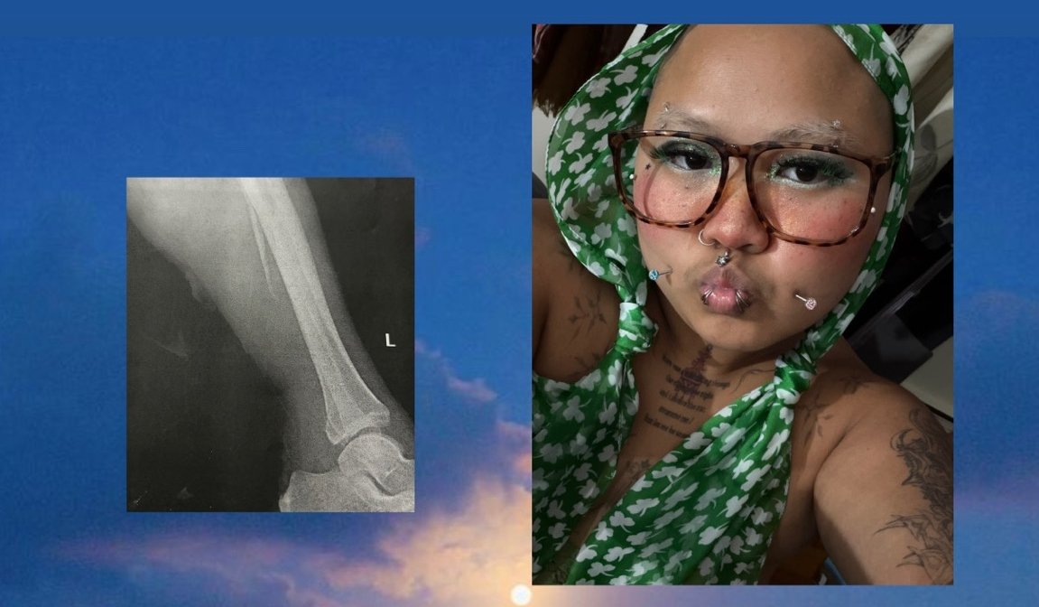 Cover Lux's Surgery and Lost Income After Leg Break campaign photo, 2 of 4