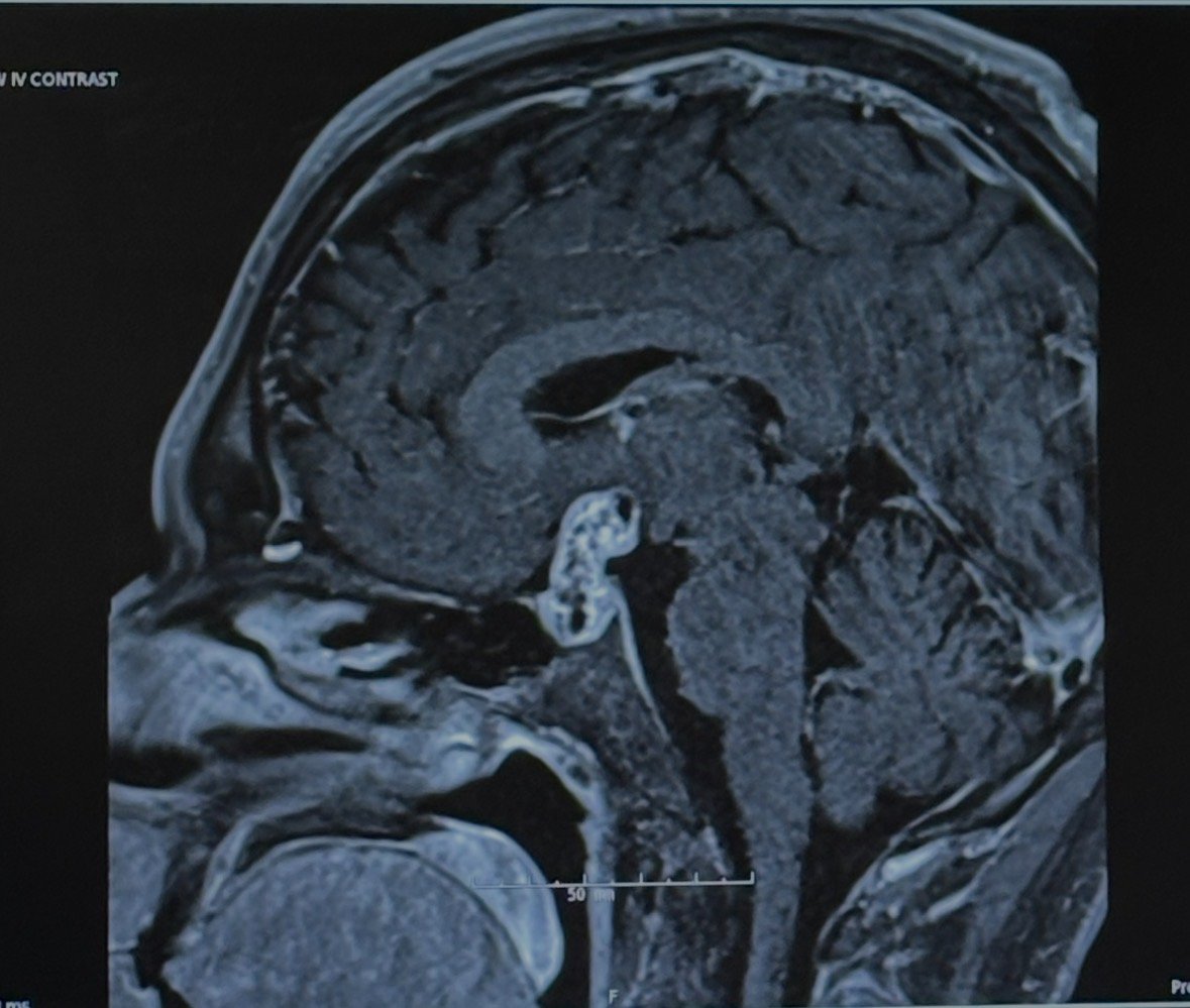 Support Jonathan's Brain Surgery and Recovery campaign photo, 7 of 8