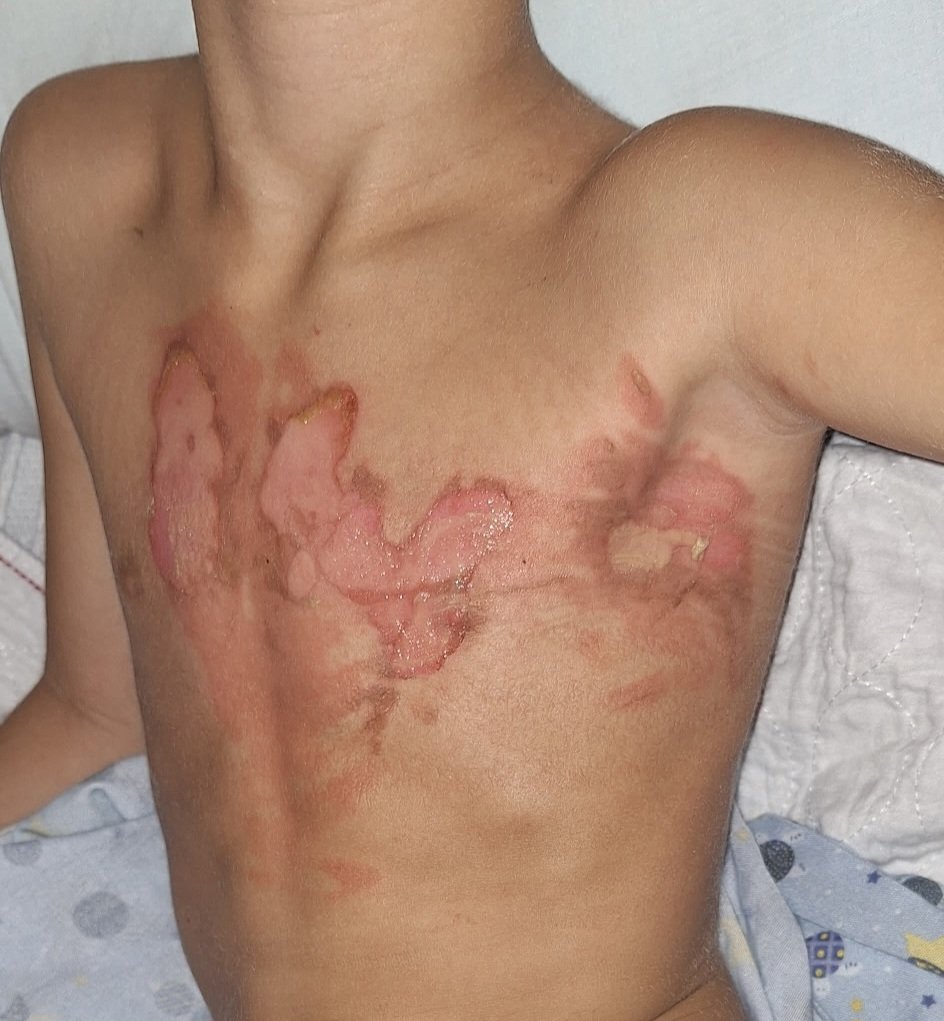Support for Nathan's Family After Severe Burns campaign photo, 2 of 8