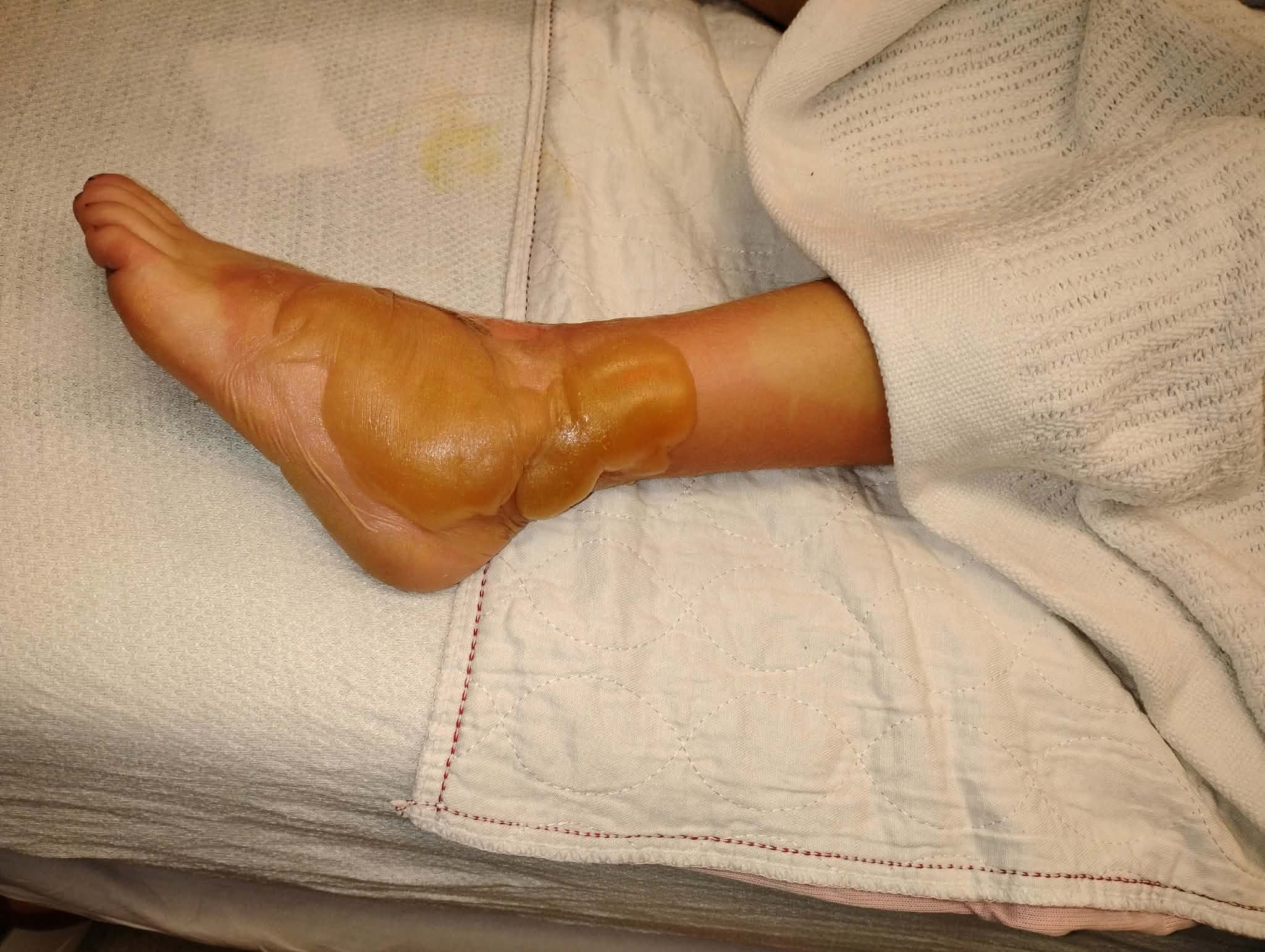 Support for Nathan's Family After Severe Burns campaign photo, 5 of 8