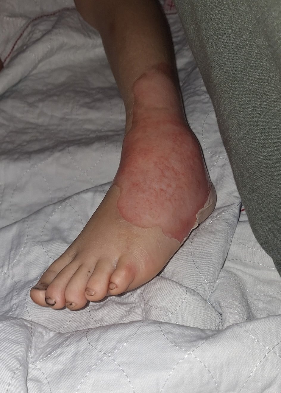 Support for Nathan's Family After Severe Burns campaign photo, 6 of 8