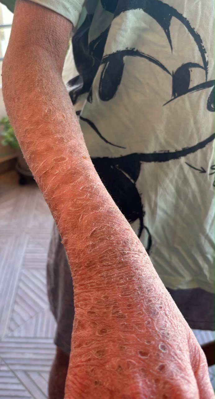 Help Us Cure Ichthyosis campaign photo, 7 of 8
