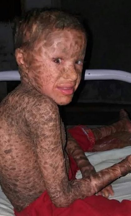 Help Us Cure Ichthyosis campaign photo, 2 of 8
