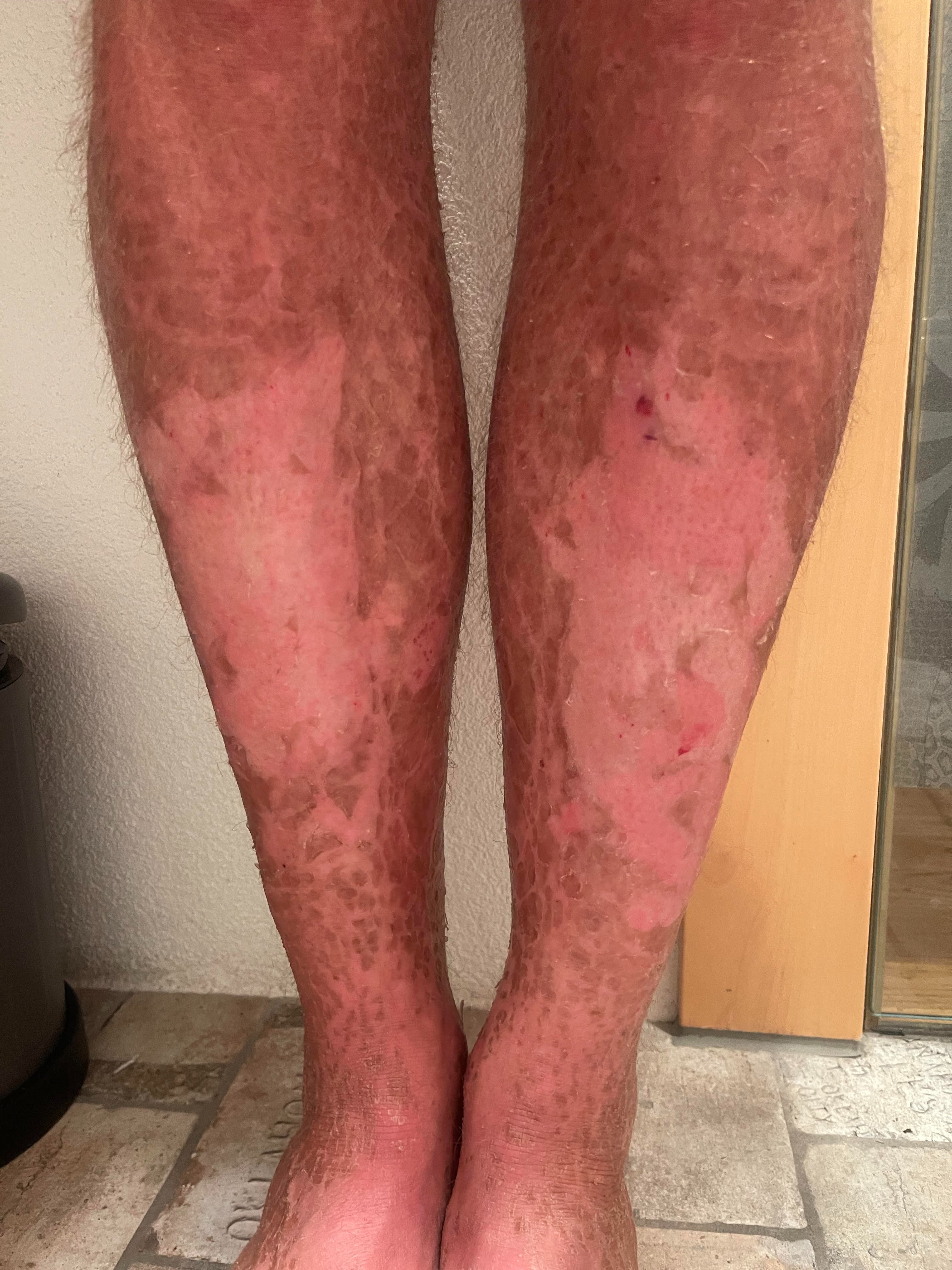 Help Us Cure Ichthyosis campaign photo, 4 of 8