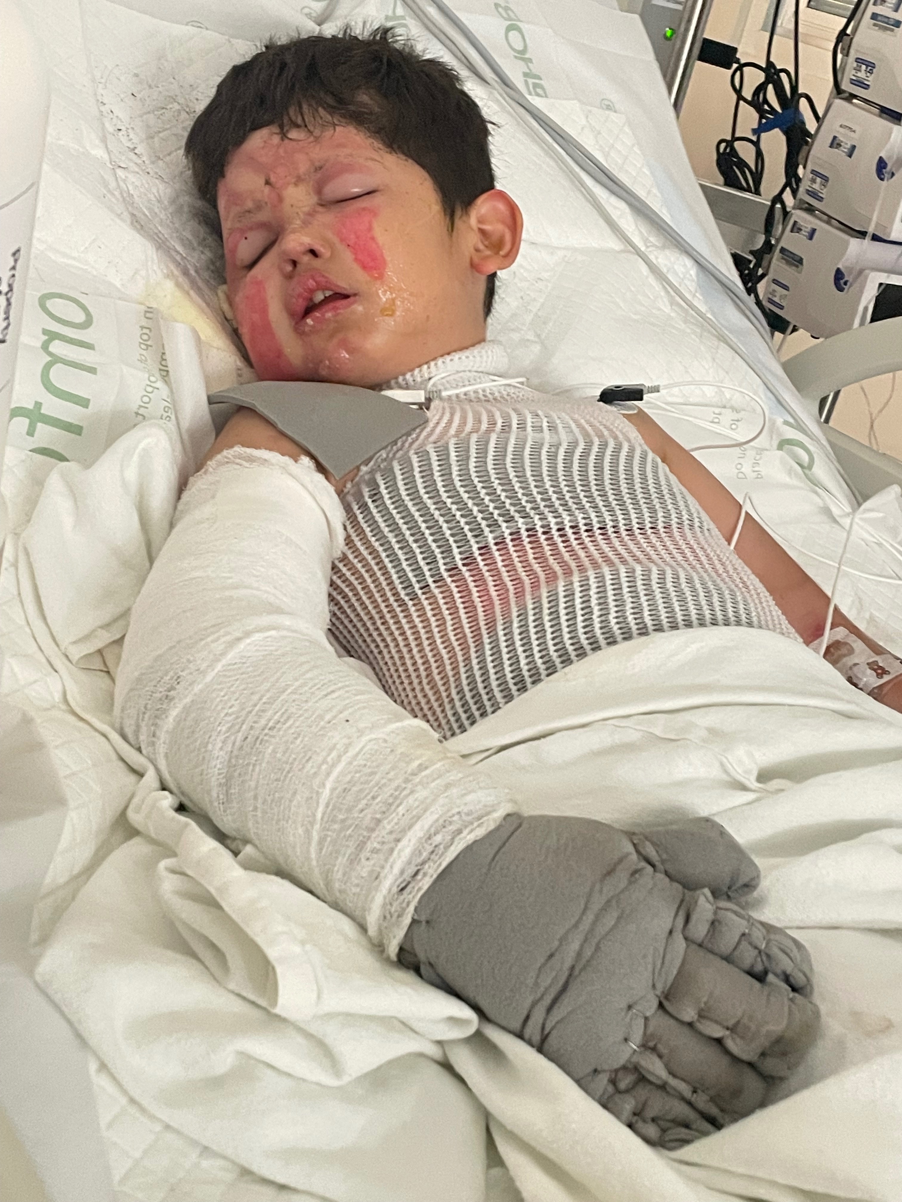 Help 7-Year-Old Elian Heal After Severe Burns campaign photo, 2 of 7