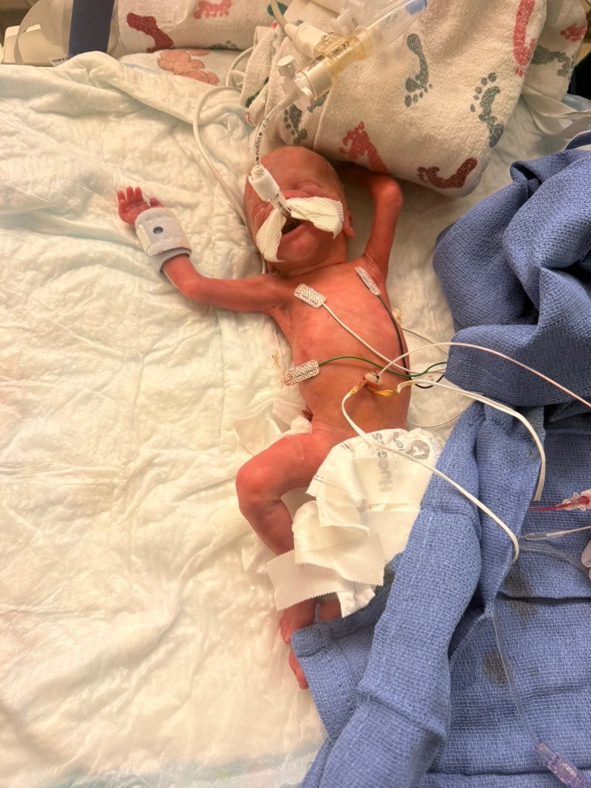 Luke's NICU Journey and Family Support campaign photo, 2 of 8