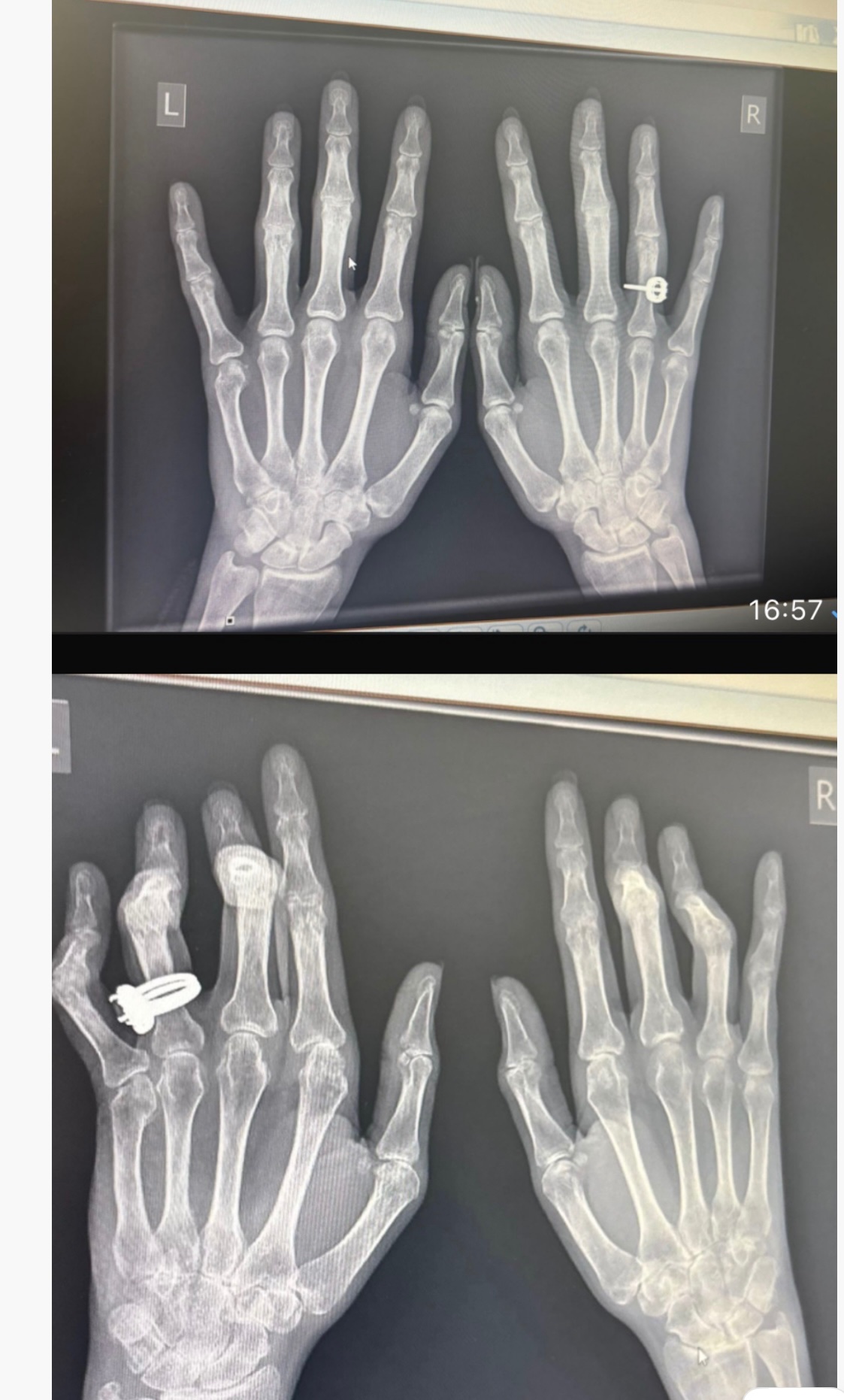 Help Me Save the Use of My Hands campaign photo, 4 of 8