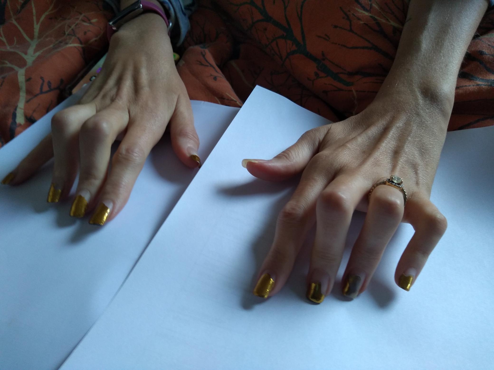 Help Me Save the Use of My Hands campaign photo, 6 of 8