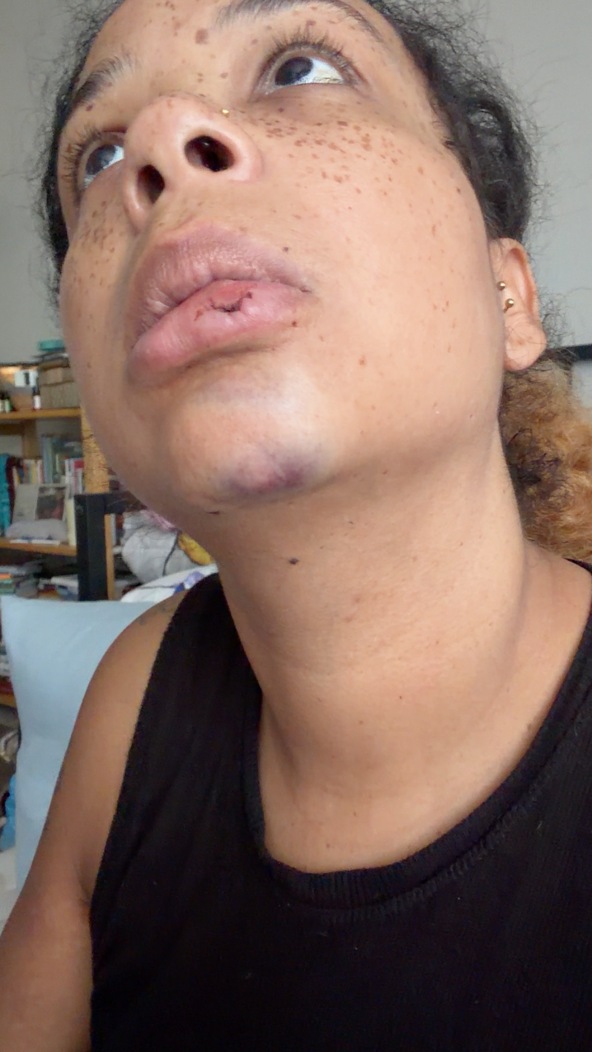 Help Save My Teeth After a Freak Accident campaign photo, 6 of 7