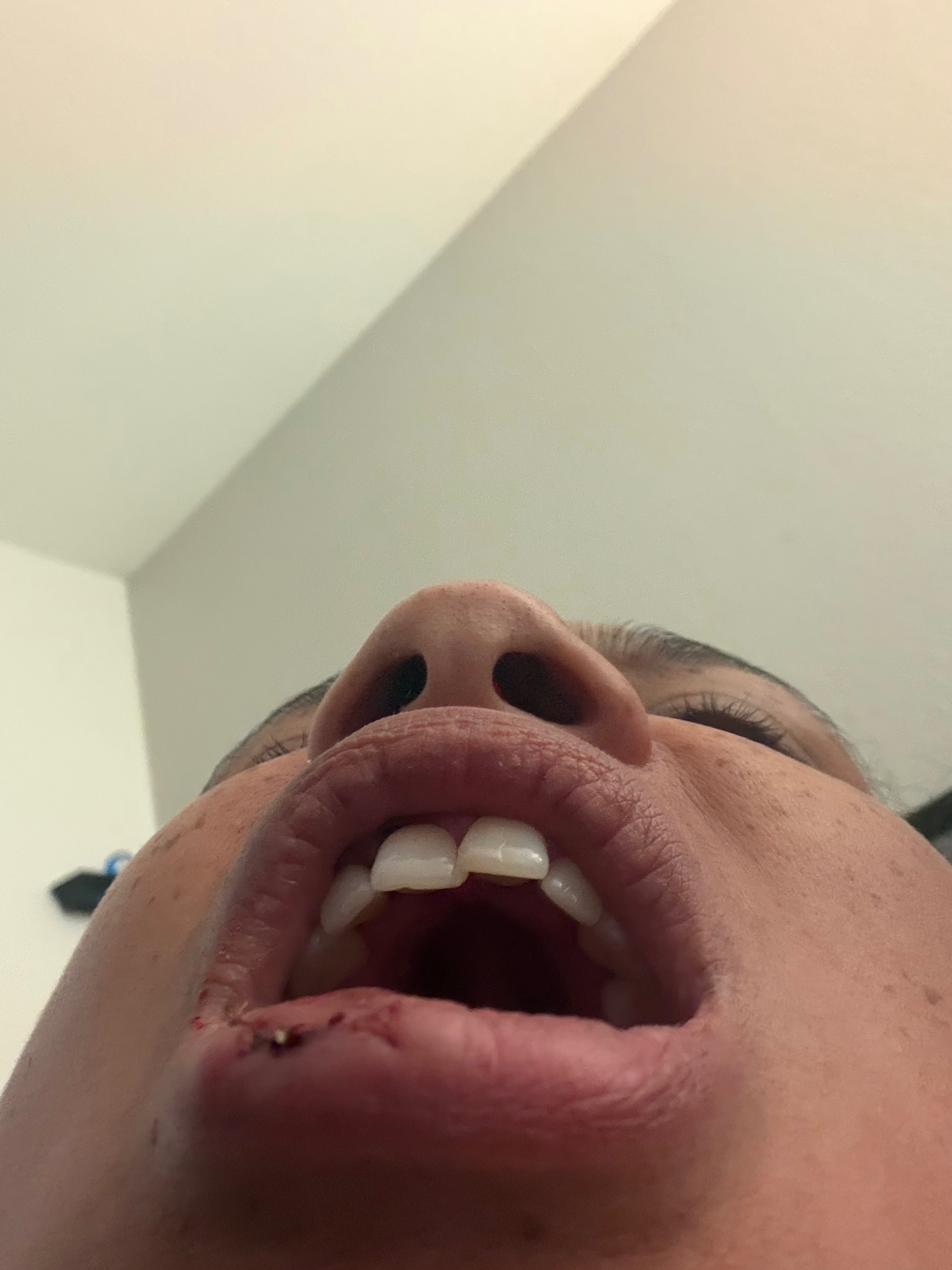 Help Save My Teeth After a Freak Accident campaign photo, 2 of 7