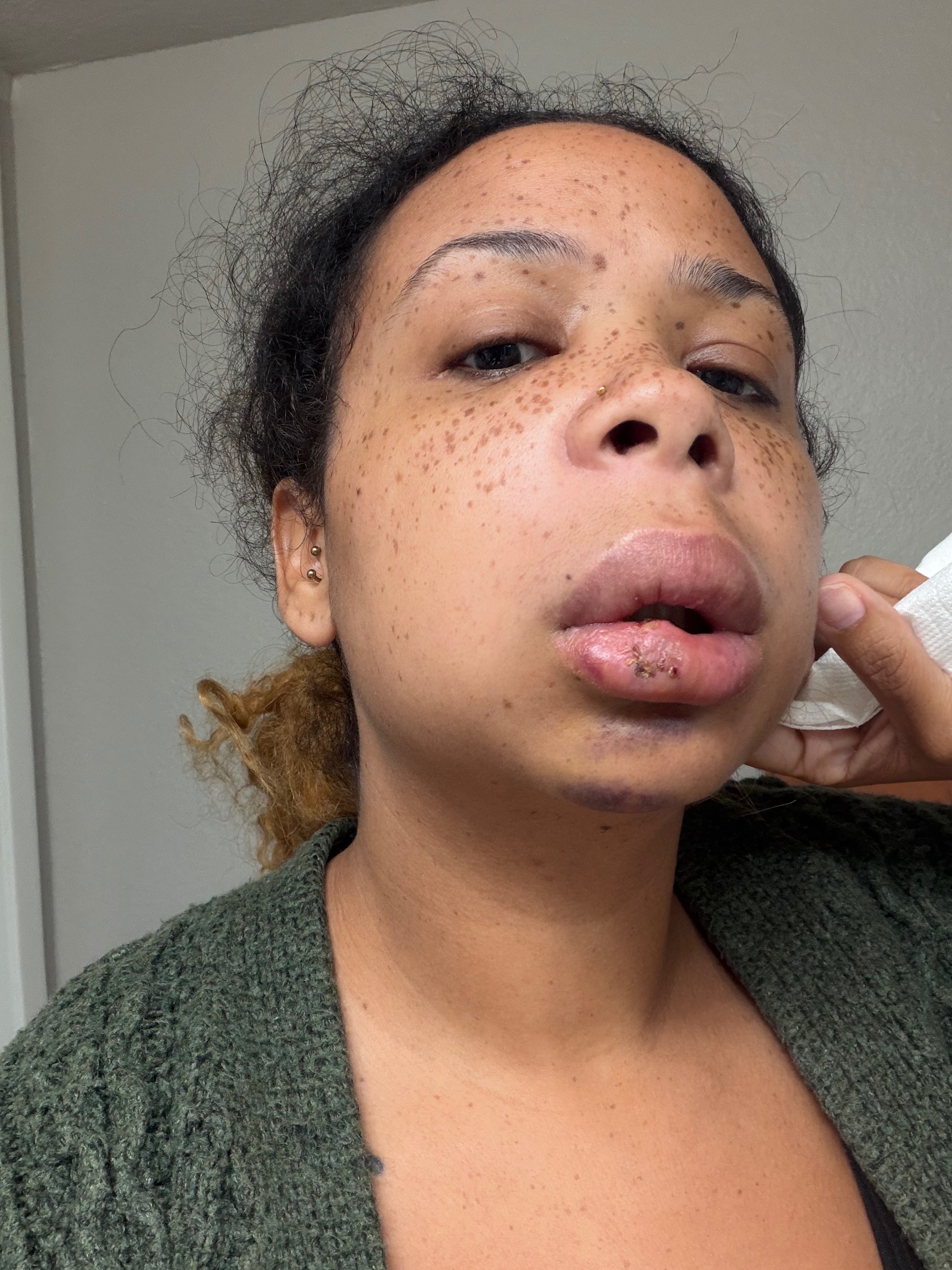 Help Save My Teeth After a Freak Accident campaign photo, 4 of 7