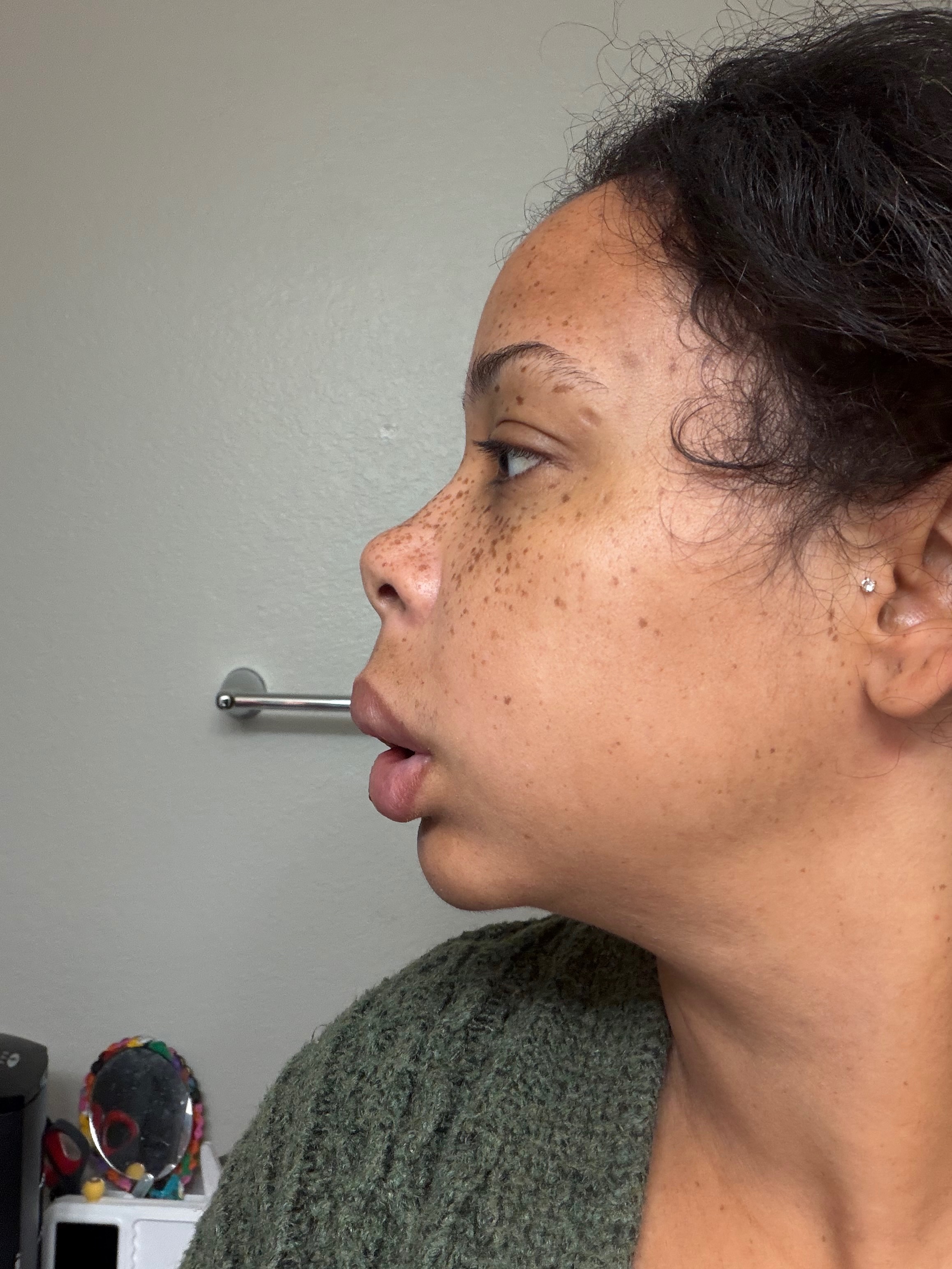 Help Save My Teeth After a Freak Accident campaign photo, 5 of 7