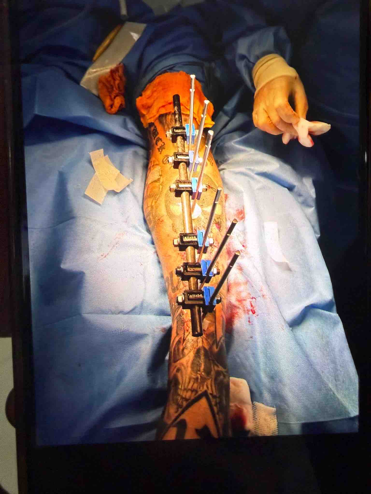 Help Jordy recover from a life changing leg injury campaign photo, 1 of 11