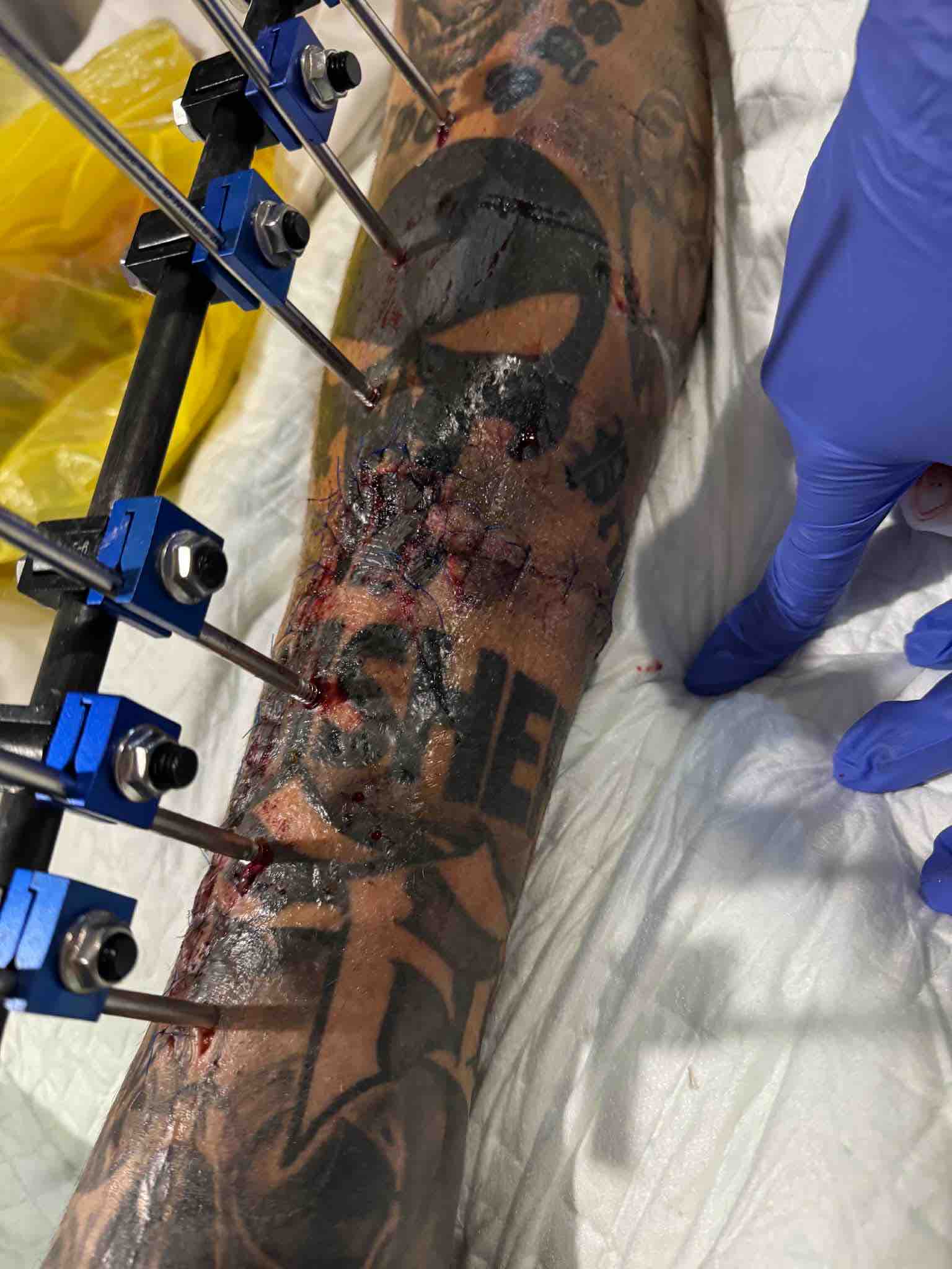 Help Jordy recover from a life changing leg injury campaign photo, 7 of 11