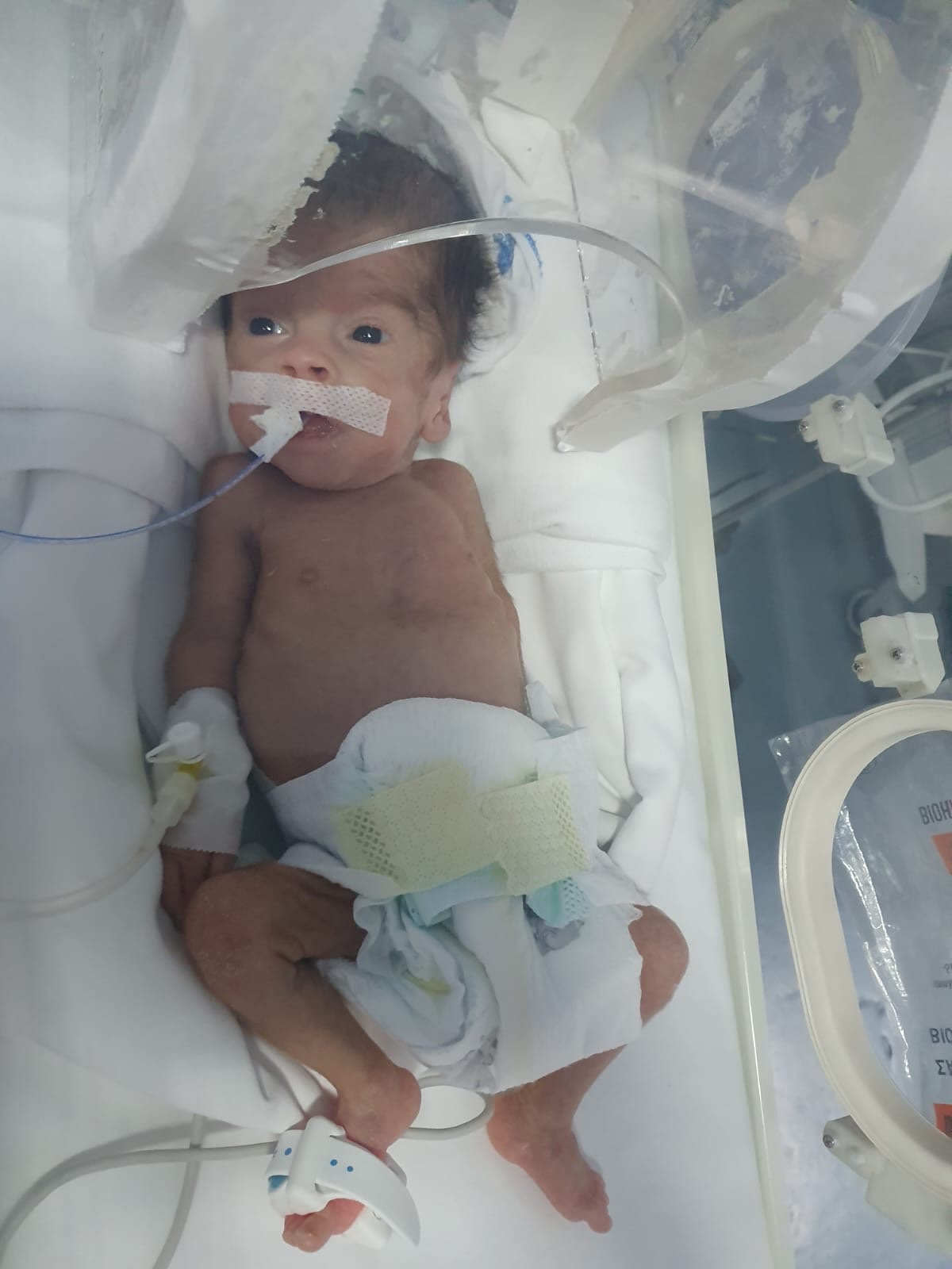 Please help Eren Afmataj 3 months old cure head cyst campaign photo, 2 of 11