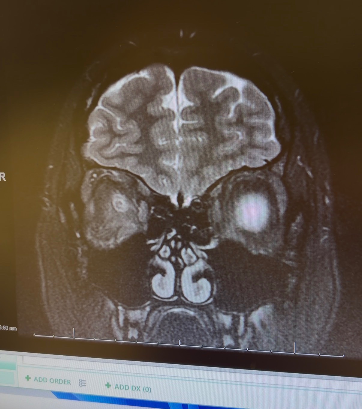 Support Deya Through Surgery, Radiation, and Recovery campaign photo, 6 of 8