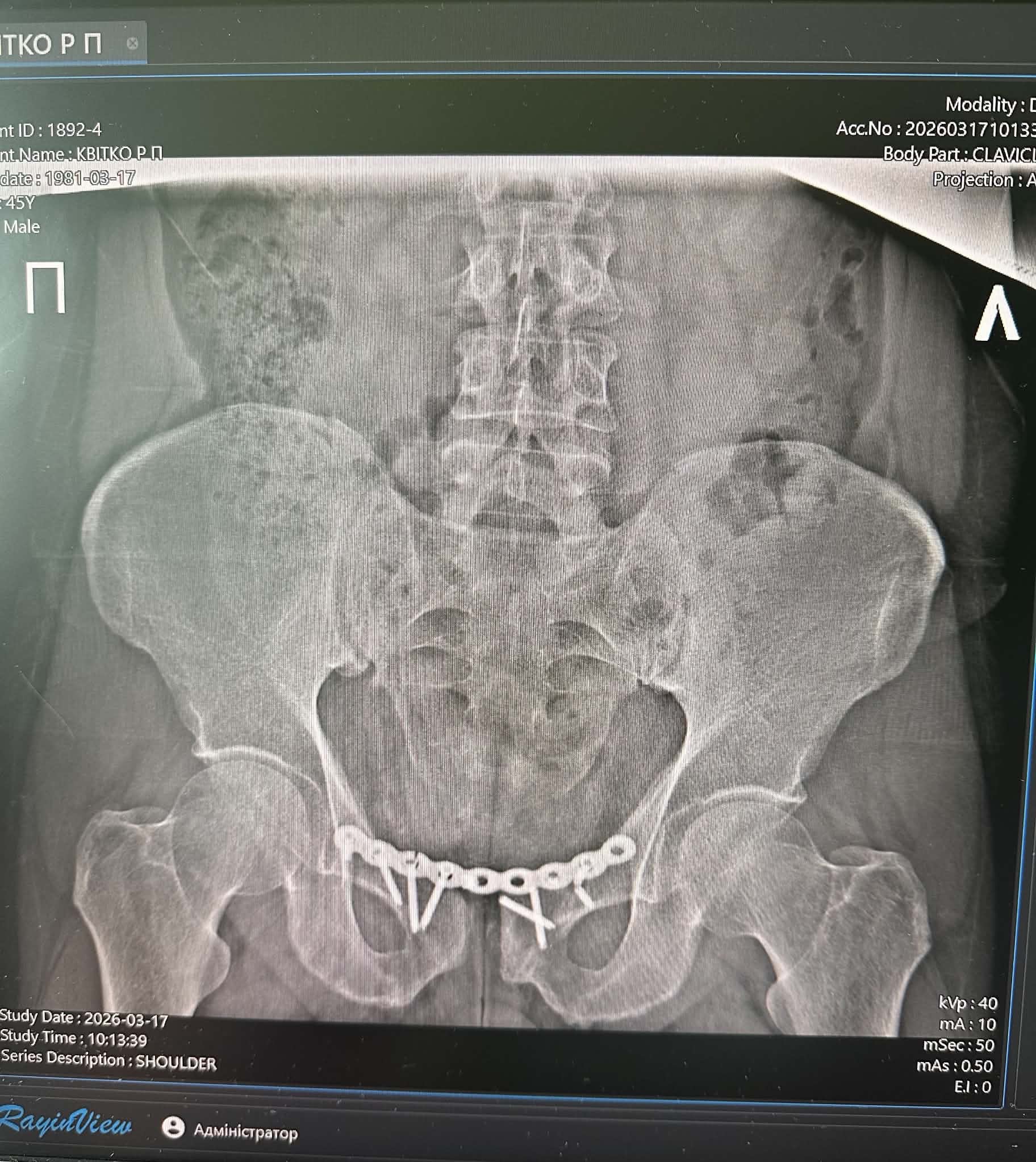Help Roman Access Specialist Treatment After a Bike Accident campaign photo, 5 of 9